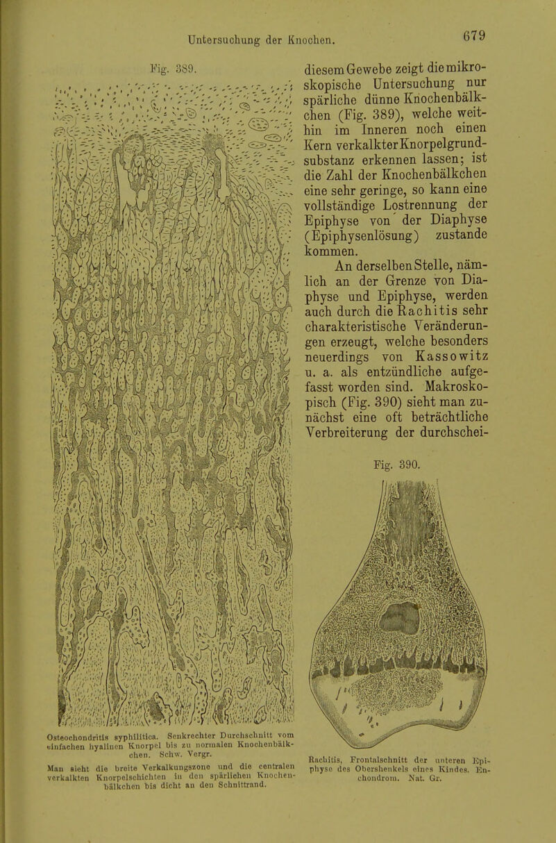 Fig. 389. 679 diesem Gewebe zeigt diemikro- skopische Untersuchung nur Ke^ii verkalkterKnorpelgrund- -^/^Ä'fe/i^; Substanz erkennen lassen; ist -■r,--^\-v<M ----- r.-, ^.^ Knochenbälkchen 'S» \P charakteristisclie Veränderun- ^) i^^f)imMMh gen erzeugt, welche besonders ^ neuerdings von Kassowitz u,, ^ y ^' ^* ^^'^ entzündliche aufge- ijf j-i, { (M ) J |i t / MV4 fasst worden sind. Makrosko- 1 N pisch (Fig. 390) sieht man zu- nächst eine oft beträchtliche Verbreiterung der durchschei- Pig. 390, Osteochondritis syphilitica. Senkrechter Durchschnitt vom einfachen hyalinen Knorpel bis zu uomialen Knoohenballt- chen. .Schw. Vorgr. Man sieht die breite Vcrltalltungsxono und die centralen pi,ysn ^j^g Obershenitpls eines Kindes. Kn- vcrliulktcn Knorpelschichtcn in den spiirliohen Knochen- Chondrom. Niit. Gr. büll«chen bis dicht an den Schnittrand. Rachitis, Frontnlschnitt der unteren Kpi-