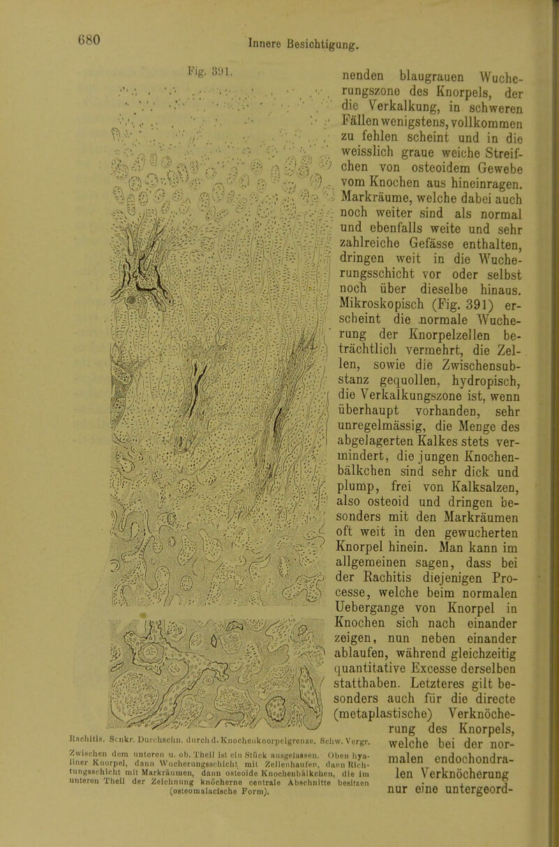 ••^■5 weiss ^äl^^l e\(^K.;A chen i ^^;''(^ - vom ] nenden blaugrauen Wuche- , ,'. rungszono des Knorpels, der ■ . die Verkalkung, in schweren '■ • Fällen wenigstens, vollkommen , •,■ . ■ .,, • . , zu fehlen scheint und in die weisslich graue weiche Streif- i von osteoidem Gewebe Knochen aus hineinragen. '[•■i Markräume, welche dabei auch noch weiter sind als normal und ebenfalls weite und sehr -^-^';;;;/f;■.-lf.-'^-^--v\r:•,'.|•'-: Zahlreiche Gefässe enthalten, Wßm'0^i:'/^^^ dringen weit in die Wuche- l^;ftfei^^'^^{^:^Si^^ rungsschicht vor oder selbst noch über dieselbe hinaus. ' ^-'^''^^l^^iS^l Mikroskopisch (Fig. 391) er- scheint die .normale AVuche- rung der Knorpelzellen be- trächtlich vermehrt, die Zel- len, sowie die Zwischensub- stanz gequollen, hydropisch, die Verkalkungszone ist, wenn überhaupt vorhanden, sehr unregelmässig, die Menge des abgelagerten Kalkes stets ver- mindert, die jungen Knochen- bälkchen sind sehr dick und li^ plump, frei von Kalksalzen, f{C:--^:^'-:;-y'fA J'^ ^^^^ osteoid und dringen be- $Ift^ r'-^^^^ y sonders mit den Markräumen '<^ß)k^^'^ V:-!-;-^^ /' ''<y ' gewucherten ' ? ' Knorpel hinein. Man kann im 3 '1 allgemeinen sagen, dass bei /^y^> der Rachitis diejenigen Pro- ^^^l^ cesse, welche beim normalen ^ Uebergange von Knorpel in Knochen sich nach einander . zeigen, nun neben einander ablaufen, während gleichzeitig ''^li^^^j'A^'^''' quantitative Excesse derselben :<.-:^^^f^^: f statthaben. Letzteres gilt be- sonders auch für die directe '■'■^^'^^ (metaplastische) Verknöche- rung des Knorpels, Rachitis. Sciikr. Durrhscliii. (liirchd.Knocheiiknorpclgroiize. Schw.Vcrgr. welcllO boi dCT UOr- ZwisKhen dem untorcn u. ob. Theil ist ein .Stück luisgelassen. Oben liyn- mnlon PnrJnf>V>nnr1rQ liner Knorpel, dann Wiicheningsscliicht mit ;Cellenhanlen, dumi Kich- '»löll CUUUbJlUUU I a- tiingsschiciit mit Markräiimen, dann osteoide Knoclienbiilkclicii, die im leU VerknÖChörUng unteren Theil der Zeiclinnng knöcherne centrale Abschnitte besitzen • . j (osteomaiacische Form). uur ome untergeoru- II®
