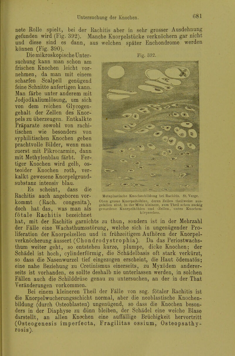 nete Rolle spielt, bei der Rachitis aber in sehr grosser Ausdehnung gefunden wird (Fig. 392). Manche Knorpelstücke verknöchern gar nicht und diese sind es dann, aus welchen später Enchondrome werden können (Fig. 390). Die mikroskopische Unter- Fig. 392. suchung kann man schon am ■^^k^^^^^^^S^^SSSS^^'-^^'^^'^'''^ frischen Knochen leicht vor- nehmen, da man mit einem scharfen Scalpell genügend feine Schnitte anfertigen kann. Man färbe unter anderem mit Jodjodkaliumlösung, um sich von dem reichen Glycogen- gehalt der Zellen des Knor- pels zu überzeugen. Entkalkte Präparate sowohl von rachi- tischen wie besonders von syphilitischen Knochen geben prachtvolle Bilder, wenn man zuerst mit Pikrocarmin, dann mit Methylenblau färbt. Fer- tiger Knochen wird gelb, os- teoider Knochen roth, ver- kalkt gewesene Knorpelgrund- substanz intensiv blau. Es scheint, dass die Rachitis auch angeboren vor- kommt (Räch, congenita), doch hat das, was man als fötale Rachitis bezeichnet hat, mit der Rachitis garnichts zu thun, sondern ist in der Mehrzahl der Fälle eine Wachsthumsstörung, welche sich in ungenügender Pro- liferation der Knorpelzellen und in frühzeitigem Aufhören der Knorpel- verknöcherung äussert (Chondrodystrophia). Da das Periostwachs- thum weiter geht, so entstehen kurze, plumpe, dicke Knochen; der Schädel ist hoch, cylinderförmig, die Schädelbasis oft stark verkürzt, so dass die Nasenwurzel tief eingezogen erscheint, die Haut ödematös; eine nahe Beziehung zu Cretinismus einerseits, zu Myxödem anderer- seits ist vorhanden, es sollte deshalb nie unterlassen werden, in solchen Fällen auch die Schilddrüse genau zu untersuchen, an der in der That Veränderungen vorkommen. Bei einem kleineren Theil der Fälle von sog. fötaler Rachitis ist die Knorpelwucherungsschicht normal, aber die neoblastische Knochen- bildung (durch Osteoblasten) ungenügend, so dass die Knochen beson- ders in der Diaphyse zu dünn bleiben, der Schädel eine weiche Blase darstellt, an allen Knochen eine aulfällige Brüchigkeit hervortritt (Osteogenesis imperfecta, Fragilitas ossium, Osteopsathy- roais). Metaplastisolie Knocheiibildung bei Rachitis. St. Vergr. Oben grosse Knorpelhöhleii, deren ZeUen theilwelso aus- gefaUen sind, in der Mitte kleinere, zum Theil schon zackig gewordene Knorpelhohlen und -Zellen, unten Knochen- korperchen.