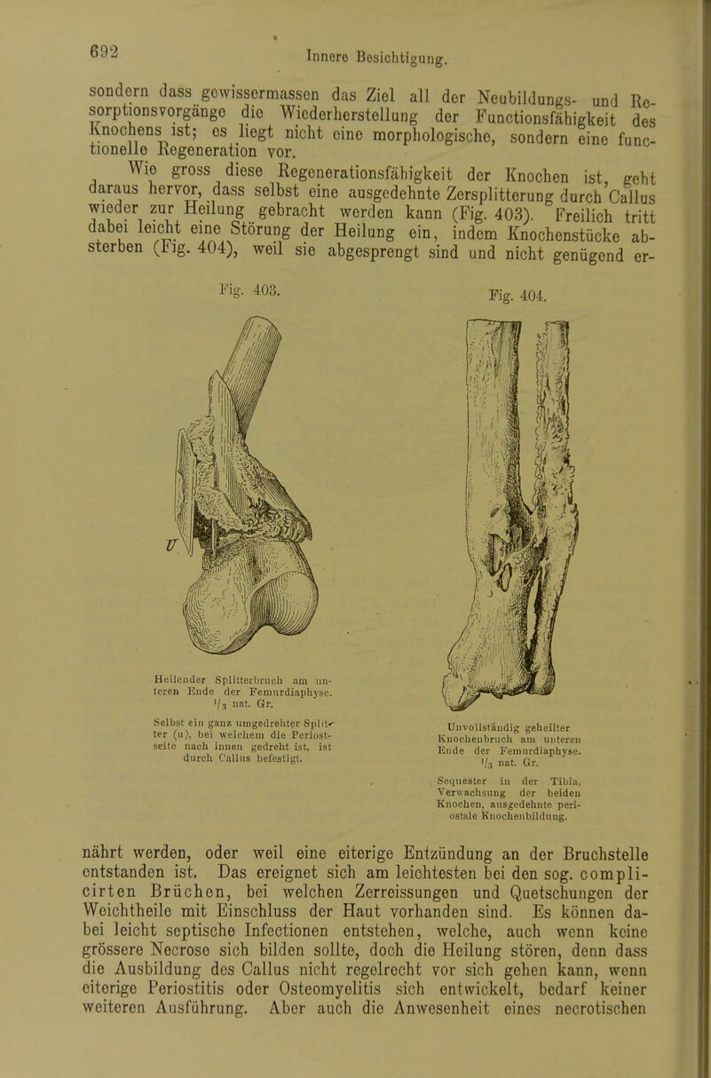 sondern dass gowissermassen das Ziel all der Neubildunes- und Rc Sorptionsvorgänge die Wiederherstellung der Functionsfähigkeit des Knochens ist; es liegt nicht eine naorphologische, sondern eine func- tionelle Kegeneration vor. Wie gross diese Regenerationsfähigkeit der Knochen ist, geht daraus hervor, dass selbst eine ausgedehnte Zersplitterung durch Gallus wieder zur Heilung gebracht werden kann (Fig. 403). Freilich tritt dabei leicht eine Störung der Heilung ein, indem Knochenstücke ab- sterben (Flg. 404), weil sie abgesprengt sind und nicht genügend er- Vig. 403. Heilender Splitterbrucli am \in- tcren Ende der Femurdiaphyse. 1/3 nat. Gr. Selbst ein ganz umgedreht?r Split«' ter (11), bei welchem die Periost- seite nach innen gedreht ist, ist durch CalUis befestigt. Fig. 404. Unvollständig geheilter Kuocheubrueh am unteren Ende der Femurdiaphyse. 1/3 nat. Gr. Secjuester in der Tibia, Verwachsung der beiden Knochen, ausgedehnte peri- ostale Knochenbildung. nährt werden, oder weil eine eiterige Entzündung an der Bruchstelle entstanden ist. Das ereignet sich am leichtesten bei den sog. compli- cirten Brüchen, bei welchen Zerreissungen und Quetschungen der Weichtheile mit Einschluss der Haut vorhanden sind. Es können da- bei leicht septische Infectionen entstehen, welche, auch wenn keine grössere Necrose sich bilden sollte, doch die Heilung stören, denn dass die Ausbildung des Gallus nicht regelrecht vor sich gehen kann, wenn eiterige Periostitis oder Osteomyelitis sich entwickelt, bedarf keiner weiteren Au.sführung. Aber auch die Anwesenheit eines necrotischen