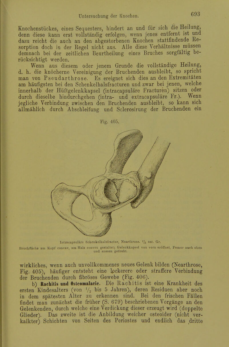 Knochenstückes, eines Sequesters, hindert an und für sich die Heilung, denn diese Jcann erst vollständig erfolgen, wenn jenes entfernt ist und dazu reicht die auch an den abgestorbenen Knochen stattfindende Re- sorption doch in der Regel nicht aus. Alle diese Verhältnisse ntiüssen demnach bei der zeitlichen Beurtheilung eines Bruches sorgfältig be- rücksichtigt werden. Wenn aus diesem oder jenem Grunde die vollständige Heilung, d. h. die knöcherne Vereinigung der Bruchenden ausbleibt, so spricht man von Pseudarthrose. Es ereignet sich dies an den Extremitäten am häufigsten bei den Schenkelhalsfracturen und zwar bei jenen, welche innerhalb der Hüftgelenkkapsel (intracapsuläre Fracturen) sitzen oder durch dieselbe hindurchgehen (intra- und extracapsuläre Fr.). Wenn jegliche Verbindung zwischen den Bruchenden ausbleibt, so kann sich allmählich durch Abschleifung und Sclerosirung der Bruchenden ein Fig. 405. Iiilracapsuläre Sclieukelhalsfractur, Nearthvose. 1(3 nat. Gr. Bruchtläclie am Kopf concav, am Hals convex gestaltet; Gelenkkapsel von vorn eröffnet, Femur nacli oben und aussen gedreht. wirkliches, wenn auch unvollkommenes neues Gelenk bilden (Nearthrose, Fig. 405), häufiger entsteht eine lockerere oder straffere Verbindung der Bruchenden durch fibröses Gewebe (Fig. 406). b) Rachiiis und Ostcomalacic. Die Rachitis ist eine Krankheit des ersten Kindesalters (von V2 bis 5 Jahren), deren Residuen aber noch in dem spätesten Alter zu erkennen sind. Bei den frischen Fällen findet man zunächst die früher (S. 679) beschriebenen Vorgänge an den Gelenkenden, durch welche eine Verdickung dieser erzeugt wird (doppelte Glieder). Das zweite ist die Anbildung weicher osteoider (nicht ver- kalkter) Schichten von Seiten des Periostes und endlich das dritte