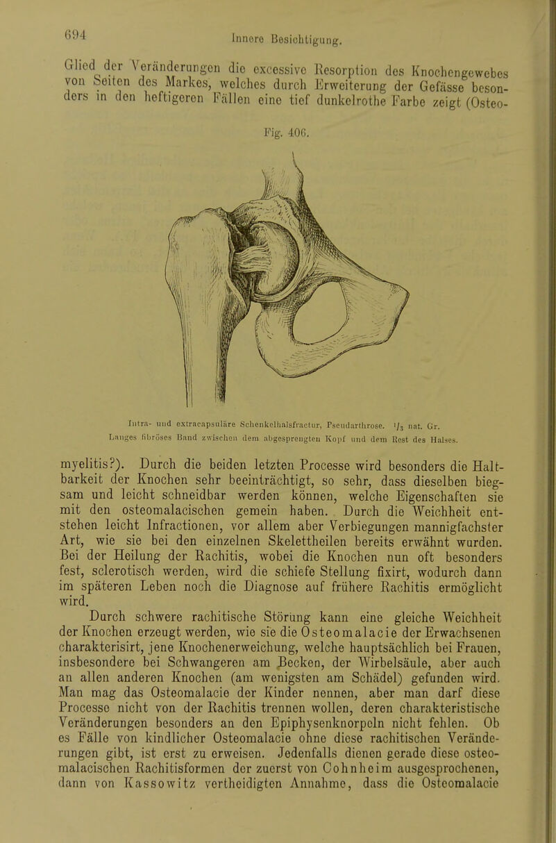 Orhed der \ eranderurgoii die excessive Resorption des Knochengewebes von leiten des Markes, welches durch Erweiterung der Gefässe beson- ders in den heftigeren Fällen eine tief dunkelrothe Farbe zeigt (Osteo- myelitis?). Durch die beiden letzten Processe wird besonders die Halt- barkeit der Knochen sehr beeinträchtigt, so sehr, dass dieselben bieg- sam und leicht schneidbar werden können, welche Eigenschaften sie mit den osteomalacischen gemein haben. Durch die Weichheit ent- stehen leicht Infractionen, vor allem aber Verbiegungen mannigfachster Art, wie sie bei den einzelnen Skelettheilen bereits erwähnt wurden. Bei der Heilung der Rachitis, wobei die Knochen nun oft besonders fest, sclerotisch werden, wird die schiefe Stellung fixirt, wodurch dann im späteren Leben noch die Diagnose auf frühere Rachitis ermöglicht wird. Durch schwere rachitische Störung kann eine gleiche Weichheit der Knochen erzeugt werden, wie sie die Osteomalacie der Erwachsenen charakterisirt, jene Knochenerweichung, welche hauptsächlich bei Frauen, insbesondere bei Schwangeren am Becken, der Wirbelsäule, aber auch an allen anderen Knochen (am wenigsten am Schädel) gefunden wird. Man mag das Osteomalacie der Kinder nennen, aber man darf diese Processe nicht von der Rachitis trennen wollen, deren charakteristische Veränderungen besonders an den Epiphysenknorpcln nicht fehlen. Ob es Fälle von kindlicher Osteomalacie ohne diese rachitischen Verände- rungen gibt, ist erst zu erweisen. Jedenfalls dienen gerade diese osteo- malacischen Rachitisformen der zuerst von Cohn he im ausgesprochenen, dann von Kassowitz vertheidigten Annahme, dass die Osteomalacie Fig. 406. Intra- und extracapsuläre Sclieiikclhalsfractiir, Pseudarthrose. 1/3 nat. Gr. Langes fibröses Band zwischen dem abgesprengten Kopf und dem liest des Halses.