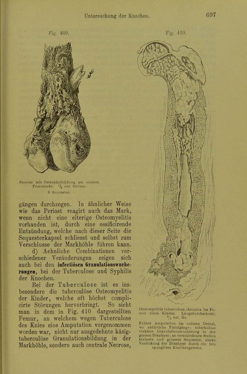 Fig. 400. Necrose mit Osteophytbildung am unteren Femurende. 1/2 nat. Grösse. S Sequester. gängen durchzogen. In ähnlicher Weise wie das Periost reagirt auch das Mark, wenn nicht eine eiterige Osteomyelitis vorhanden ist, durch eine ossificirende Entzündung, welche nach dieser Seite die Sequesterkapsel schliesst und selbst zum Verschlusse der Markhöhle führen kann. d) Aehnliche Combinationen ver- schiedener Veränderungen zeigen sich auch bei den infectiöscii Granulationswuche- Tungen, bei der Tuherculose und Syphilis der Knochen. Bei der Tuherculose ist es ins- besondere die tuherculose Osteomyelitis der Kinder, welche oft höchst compli- cirte Störungen hervorbringt. So sieht man in dem in Fig. 410 dargestellten Femur, an welchem wegen Tuherculose des Knies eine Amputation vorgenommen worden war, nicht nur ausgedehnte käsig- tuberculöse Granulationsbildung in der Markhöhle, sondern auch centrale Necrose, Fig. 410. Osieomyolilis luberculosa chronica im Fe- iiiiir eines Kindes. Liingsdiirclisclinitt. nat. Gr. Früher Amputation im unteren Drittel, wo zalilreielio Fistelgänge; tubcrlcnlöse verkäste (jlraiuilationswiiohcrnng in dor ganzen Diaphyso; an verschiedenen Stellen kleinere und grossere Sequester, starke Verdickung der Diaphyse durch ein fein spongtüscs Knochengewebe.
