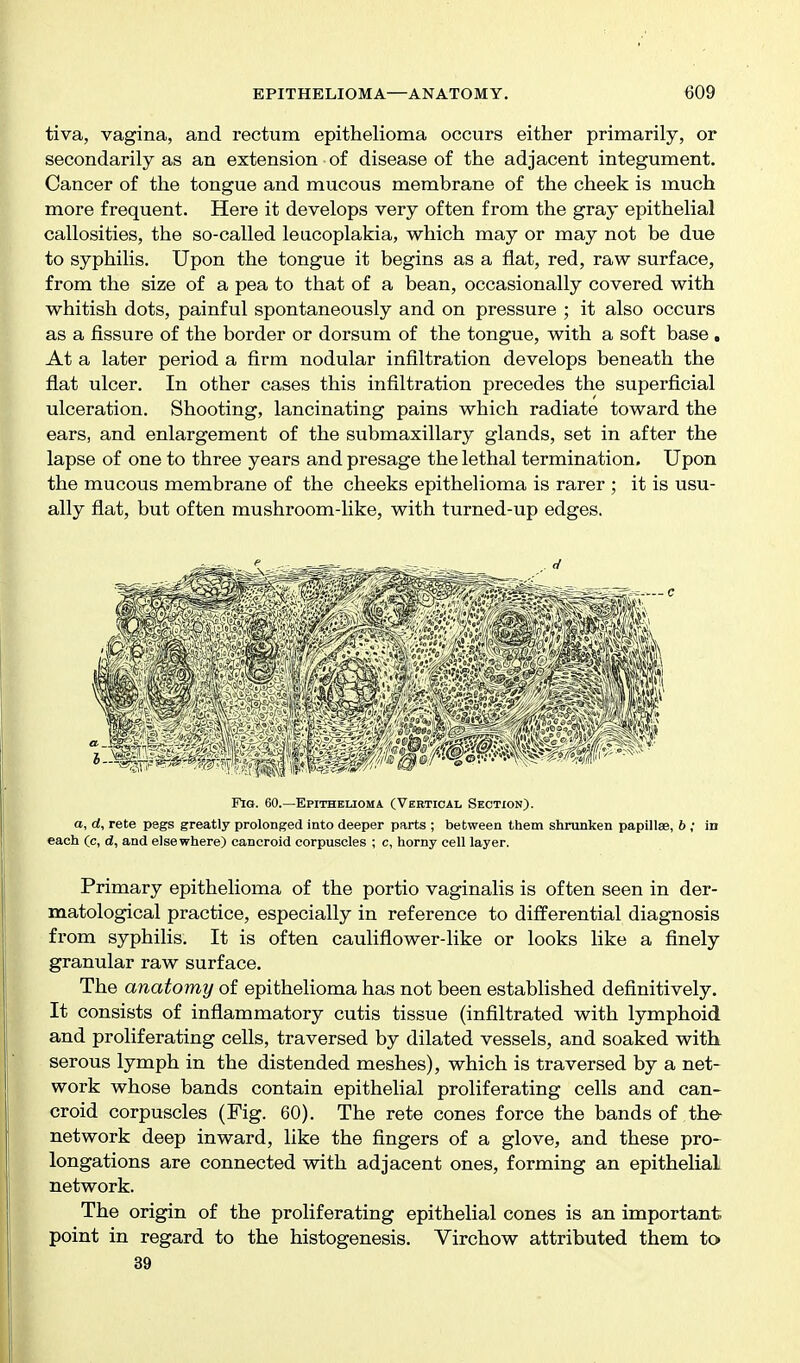 tiva, vagina, and rectum epithelioma occurs either primarily, or secondarily as an extension of disease of the adjacent integument. Cancer of the tongue and mucous membrane of the cheek is much more frequent. Here it develops very often from the gray epithelial callosities, the so-called leucoplakia, which may or may not be due to syphilis. Upon the tongue it begins as a flat, red, raw surface, from the size of a pea to that of a bean, occasionally covered with whitish dots, painful spontaneously and on pressure ; it also occurs as a fissure of the border or dorsum of the tongue, with a soft base , At a later period a firm nodular infiltration develops beneath the flat ulcer. In other cases this infiltration precedes the superficial ulceration. Shooting, lancinating pains which radiate toward the ears, and enlargement of the submaxillary glands, set in after the lapse of one to three years and presage the lethal termination. Upon the mucous membrane of the cheeks epithelioma is rarer ; it is usu- ally flat, but often mushroom-like, with turned-up edges. FiQ. 60.—Epithelioma (Vertical Section). a, d, rete pegs greatly prolonged into deeper parts ; between them shrunken papillae, b ; in each (c, d, and elsewhere) cancroid corpuscles ; c, horny cell layer. Primary epithelioma of the portio vaginalis is often seen in der- matological practice, especially in reference to differential diagnosis from syphilis. It is often cauliflower-like or looks like a finely granular raw surface. The anatomy of epithelioma has not been established definitively. It consists of inflammatory cutis tissue (infiltrated with lymphoid and proliferating cells, traversed by dilated vessels, and soaked with serous lymph in the distended meshes), which is traversed by a net- work whose bands contain epithelial proliferating cells and can- croid corpuscles (Fig. 60). The rete cones force the bands of the- network deep inward, like the fingers of a glove, and these pro- longations are connected with adjacent ones, forming an epithelial network. The origin of the proliferating epithelial cones is an important point in regard to the histogenesis. Virchow attributed them to 39
