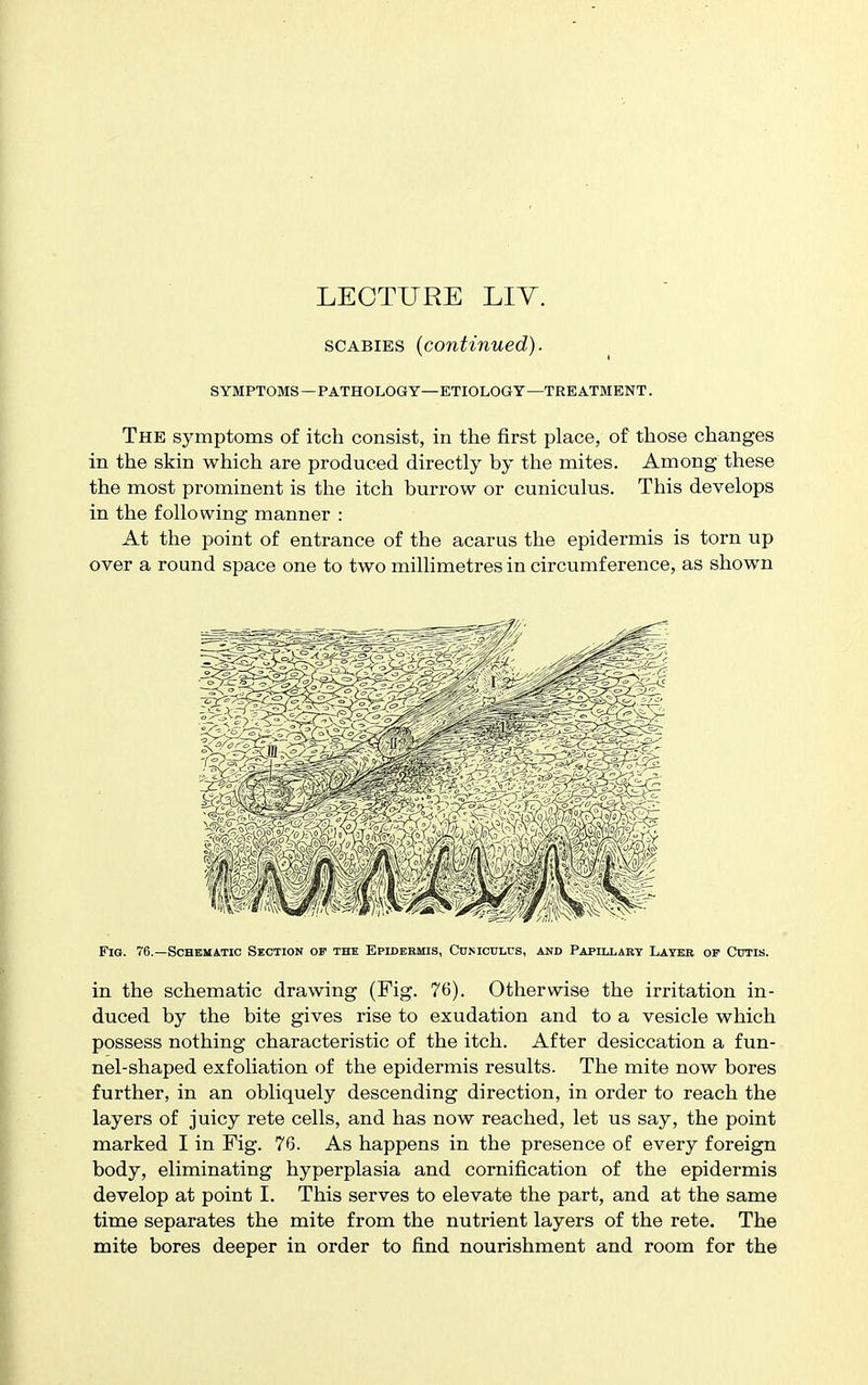 SCABIES {continued). SYMPTOMS —PATHOLOGY—ETIOLOGY—TREATMENT. The symptoms of itch consist, in the first place, of those changes in the skin which are produced directly by the mites. Among these the most prominent is the itch burrow or cuniculus. This develops in the following manner : At the point of entrance of the acarus the epidermis is torn up over a round space one to two millimetres in circumference, as shown Fig. 76.—Schematic Section of the Epidermis, Cumculcs, and Papillary Layer op Cutis. in the schematic drawing (Fig. 76). Otherwise the irritation in- duced by the bite gives rise to exudation and to a vesicle which possess nothing characteristic of the itch. After desiccation a fun- nel-shaped exfoliation of the epidermis results. The mite now bores further, in an obliquely descending direction, in order to reach the layers of juicy rete cells, and has now reached, let us say, the point marked I in Fig. 76. As happens in the presence of every foreign body, eliminating hyperplasia and cornification of the epidermis develop at point I. This serves to elevate the part, and at the same time separates the mite from the nutrient layers of the rete. The mite bores deeper in order to find nourishment and room for the