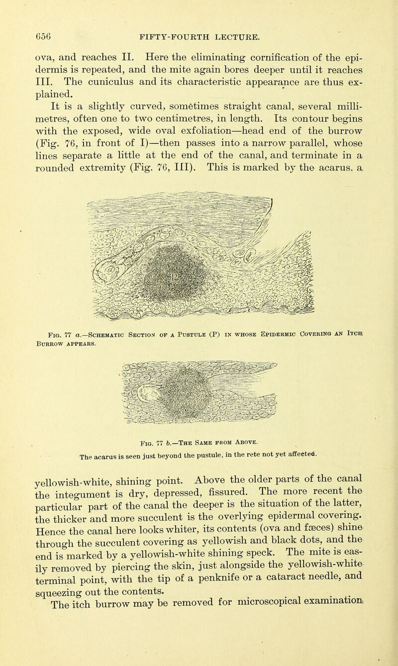 ova, and reaches II. Here the ehminating cornification of the epi- dermis is repeated, and the mite again bores deeper until it reaches III. The cuniculus and its characteristic appearance are thus ex- plained. It is a slightly curved, sometimes straight canal, several milli- metres, often one to two centimetres, in length. Its contour begins with the exposed, wide oval exfoliation—head end of the burrow (Fig. 76, in front of I)—then passes into a narrow parallel, whose lines separate a little at the end of the canal, and terminate in a rounded extremity (Fig. 76, III). This is marked by the acarus, a Fig. 77 a.—Schematic Section of a Pustule (P) in whose Epidermic Covering an iTca Burrow appears. Fig. 77 6.—The Same from Above. The acams is seen just beyond the pustule, in the rate not yet affected. yellowish-white, shining point. Above the older parts of the canal the integument is dry, depressed, fissured. The more recent the particular part of the canal the deeper is the situation of the latter, the thicker and more succulent is the overlying epidermal covering. Hence the canal here looks whiter, its contents (ova and fasces) shine through the succulent covering as yellowish and black dots, and the end is marked by a yellowish-white shining speck. The mite is eas- ily removed by piercing the skin, just alongside the yellowish-white terminal point, with the tip of a penknife or a cataract needle, and squeezing out the contents. The itch burrow may be removed for microscopical examination,