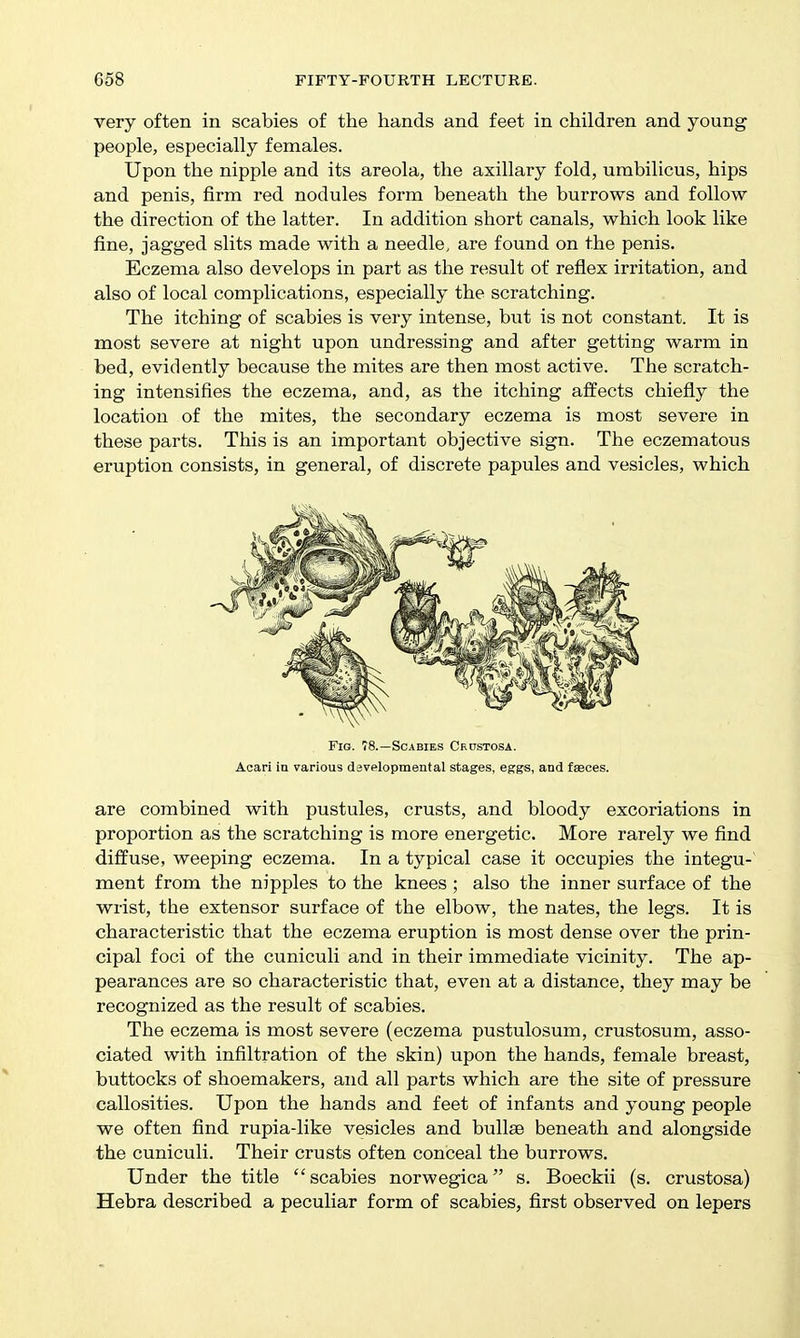 very often in scabies of the hands and feet in children and young people, especially females. Upon the nipple and its areola, the axillary fold, umbilicus, hips and penis, firm red nodules form beneath the burrows and follow the direction of the latter. In addition short canals, which look like fine, jagged slits made with a needle, are found on the penis. Eczema also develops in part as the result of reflex irritation, and also of local complications, especially the scratching. The itching of scabies is very intense, but is not constant. It is most severe at night upon undressing and after getting warm in bed, evidently because the mites are then most active. The scratch- ing intensifies the eczema, and, as the itching affects chiefiy the location of the mites, the secondary eczema is most severe in these parts. This is an important objective sign. The eczematous eruption consists, in general, of discrete papules and vesicles, which Fig. 78.—Scabies Crcstosa. Acari in various dsvelopmental stages, eggs, and fasces. are combined with pustules, crusts, and bloody excoriations in proportion as the scratching is more energetic. More rarely we find diffuse, weeping eczema. In a typical case it occupies the integu-' ment from the nipples to the knees ; also the inner surface of the wrist, the extensor surface of the elbow, the nates, the legs. It is characteristic that the eczema eruption is most dense over the prin- cipal foci of the cuniculi and in their immediate vicinity. The ap- pearances are so characteristic that, even at a distance, they may be recognized as the result of scabies. The eczema is most severe (eczema pustulosum, crustosum, asso- ciated with infiltration of the skin) upon the hands, female breast, buttocks of shoemakers, and all parts which are the site of pressure callosities. Upon the hands and feet of infants and young people we often find rupia-like vesicles and bullae beneath and alongside the cuniculi. Their crusts often conceal the burrows. Under the title scabies norwegica s. Boeckii (s. crustosa) Hebra described a peculiar form of scabies, first observed on lepers