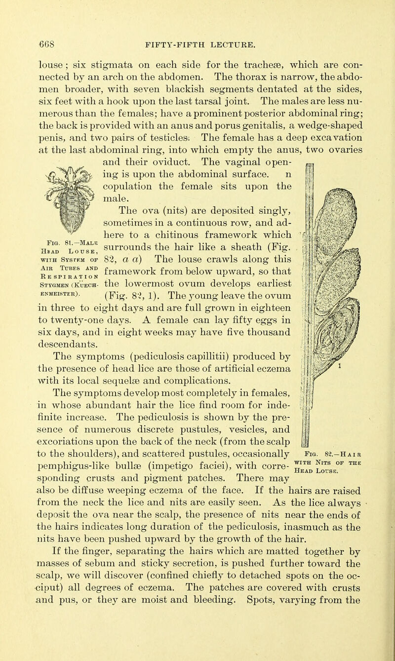 Fig. 81.—Male Hbad Louse, WITH Syspkm of Air Tubes and Respiration Styqmen (Kueoh- bnmeisteb). louse; six stigmata on each side for the trachese, which are con- nected by an arch on the abdomen. The thorax is narrow, the abdo- men broader, with seven blackish segments dentated at the sides, six feet with a hook upon the last tarsal joint. The males are less nu- merous than the females; have a prominent posterior abdominal ring; the back is provided with an anus and porus genitalis, a wedge-shaped penis, and two pairs of testicles-. The female has a deep excavation at the last abdominal ring, into which empty the anus, two ovaries and their oviduct. The vaginal open- ing is upon the abdominal surface. n copulation the female sits upon the male. The ova (nits) are deposited singly, sometimes in a continuous row, and ad- here to a chitinous framework which surrounds the hair like a sheath (Fig. 82, a a) The louse crawls along this framework from below upward, so that the lowermost ovum develops earliest (Fig. 8'i, 1). The young leave the ovum in three to eight days and are full grown in eighteen to twenty-one days. A female can lay fifty eggs in six days, and in eight weeks may have five thousand descendants. The symptoms (pediculosis capillitii) produced by the presence of head lice are those of artificial eczema with its local sequelse and complications. The symptoms develop most completely in females, in whose abundant hair the lice find room for inde- finite increase. The pediculosis is shown by the pre- sence of numerous discrete pustules, vesicles, and excoriations upon the back of the neck (from the scalp to the shoulders), and scattered pustules, occasionally pemphigus-like bullae (impetigo faciei), with corre- sponding crusts and pigment patches. There may also be diffuse weeping eczema of the face. If the hairs are raised from the neck the lice and nits are easily seen. As the lice always deposit the ova near the scalp, the presence of nits near the ends of the hairs indicates long duration of the pediculosis, inasmuch as the nits have been pushed upward by the growth of the hair. If the finger, separating the hairs which are matted together by masses of sebum and sticky secretion, is pushed further toward the scalp, we will discover (confined chiefly to detached spots on the oc- ciput) all degrees of eczema. The patches are covered with crusts and pus, or they are moist and bleeding. Spots, varying from the Fig. 8a.-HAia WITH Nits op the Head LorsE.