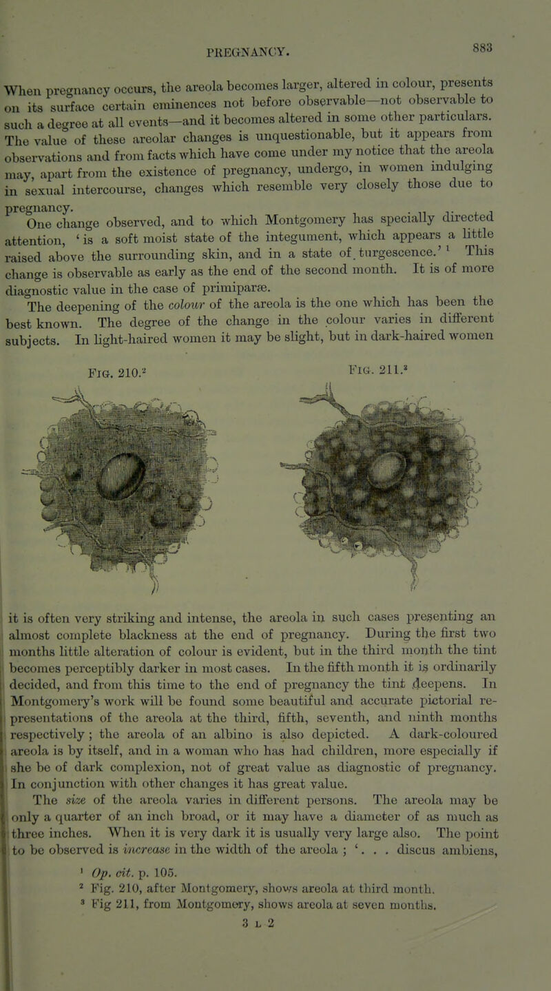 When precrnancy occurs, the areohx becomes larger, altered in colour, presents on its surface certain eminences not before observable-not observable to such a decree at all events-and it becomes altered in some other particulars. The valuJ of these areolar changes is unquestionable, but it appears from observations and from facts which have come under my notice that the areola may apart from the existence of pregnancy, undergo, in women indulging in sexual intercourse, changes which resemble very closely those due to pregnancy. One change observed, and to which Montgomery has specially directed attention, ' is a soft moist state of the integument, which appears a little raised above the surrounding skin, and in a state of. tnrgescence.' ' This change is observable as early as the end of the second month. It is of more diagnostic value in the case of primiparfe. The deepening of the colour of the areola is the one which has been the best known. The degree of the change in the colour varies in different subjects. In light-haired women it may be slight, but in dark-haired women Fig. 210.'^ Fig. 211.» it is often very striking and intense, the areola in such cases presenting an almost complete blackness at the end of pregnancy. During the first two months little alteration of colour is evident, but in the third month the tint becomes perceptibly darker in most cases. In the fifth month it i^i ordinarily decided, and from this time to the end of pregnancy the tint .deepens. In Montgomery's work will be found some beautiful and accurate pictorial re- presentaticms of the areola at the third, fifth, seventh, and ninth months respectively ; the areola of an albino is also depicted. A dark-coloured . areola is by itself, and in a woman who has had children, more especially if I she be of dark complexion, not of great value as diagnostic of pregnancy. In conjunction with other changes it has great value. The si2€ of the areola varies in different persons. The areola may be only a quarter of an inch broad, or it may have a diameter of as much as three inches. When it is very dark it is usually very large also. The point to be observed is increase in the width of the areola ; '. . . discus ambiens, ' Op. cit. p. 105. i * Fig. 210, after Montgomery, shoves areola at third month. ^ Fig 211, from Montgomery, shows areola at seven months. 3 L 2