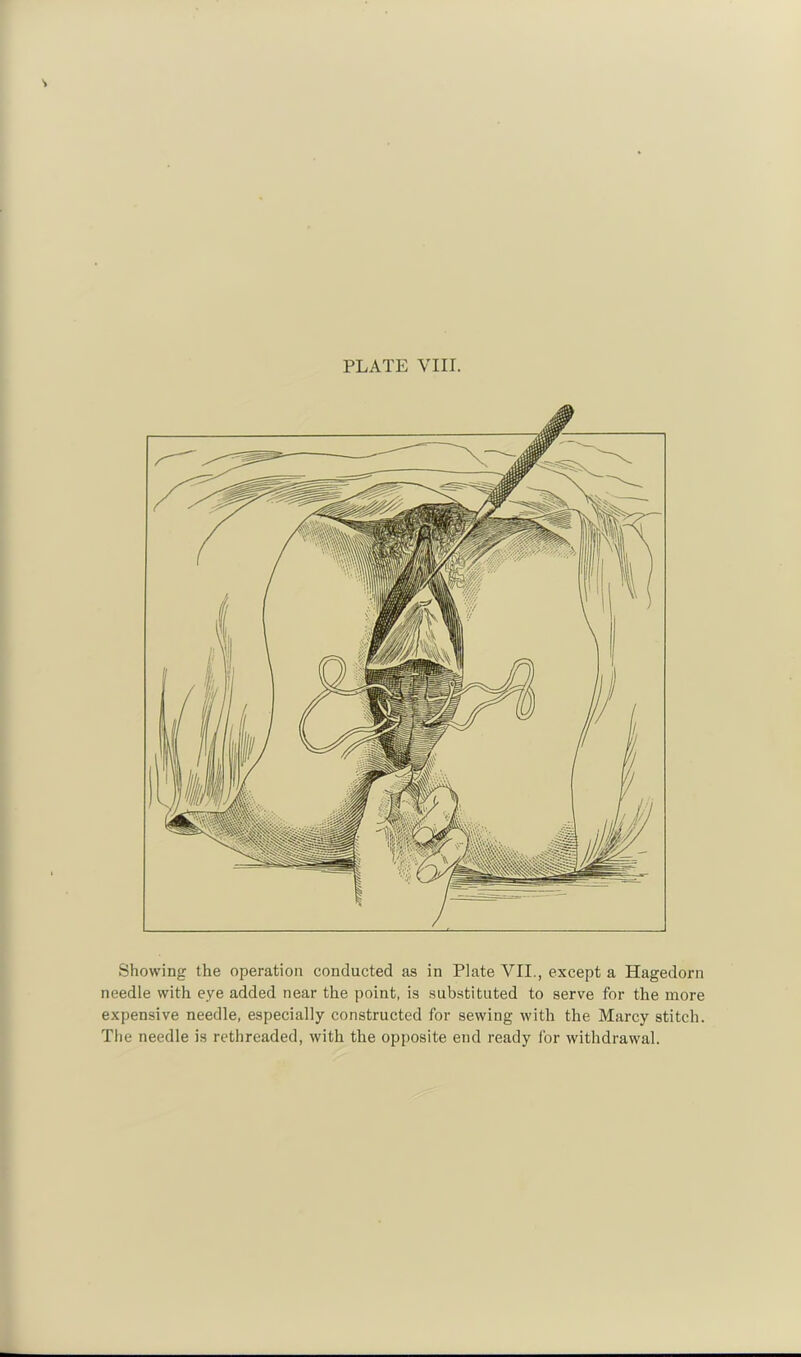 Showing the operation conducted as in Plate VII., except a Hagedorn needle with eye added near the point, is substituted to serve for the more expensive needle, especially constructed for sewing with the Marcy stitch. The needle is rethreaded, with the opposite end ready for withdrawal.