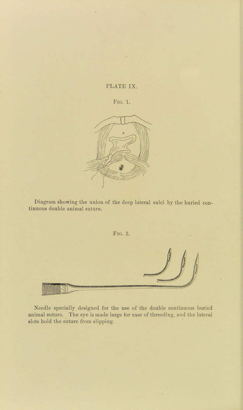 Fig. 1. Diagram showing the union of the deep lateral sulci by the buried con- tinuous double animal suture. Fig. 2. Needle specially designed for the use of the double continuous buried animal suture. The eye is made large for ease of threading, and the lateral slots hold the suture from slipping.