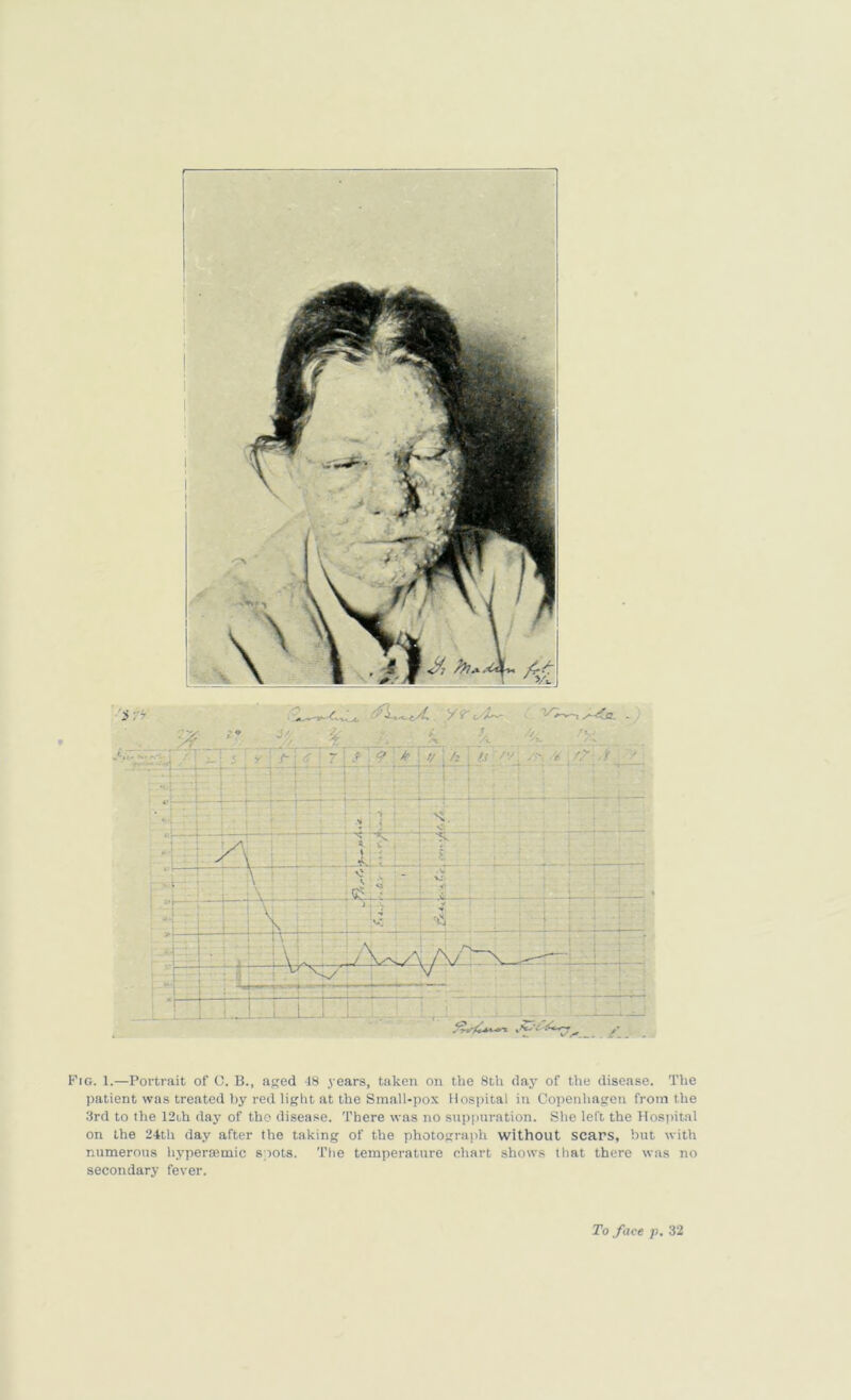 Fig. 1.—Portrait of O. B., a^ed 18 years, taken on the 8th daj’ of the disease. The patient was treated Ijy red light at the Small-pox llosihtal in Copenhagen from the 3rd to the 12i,h day of tho disease. There was no suppuration. She left the Hospital on the 24th day after the taking of the photograph without scars, but with numerous hypersemic spots. Tlie temperature chart shows that there was no secondary fever.