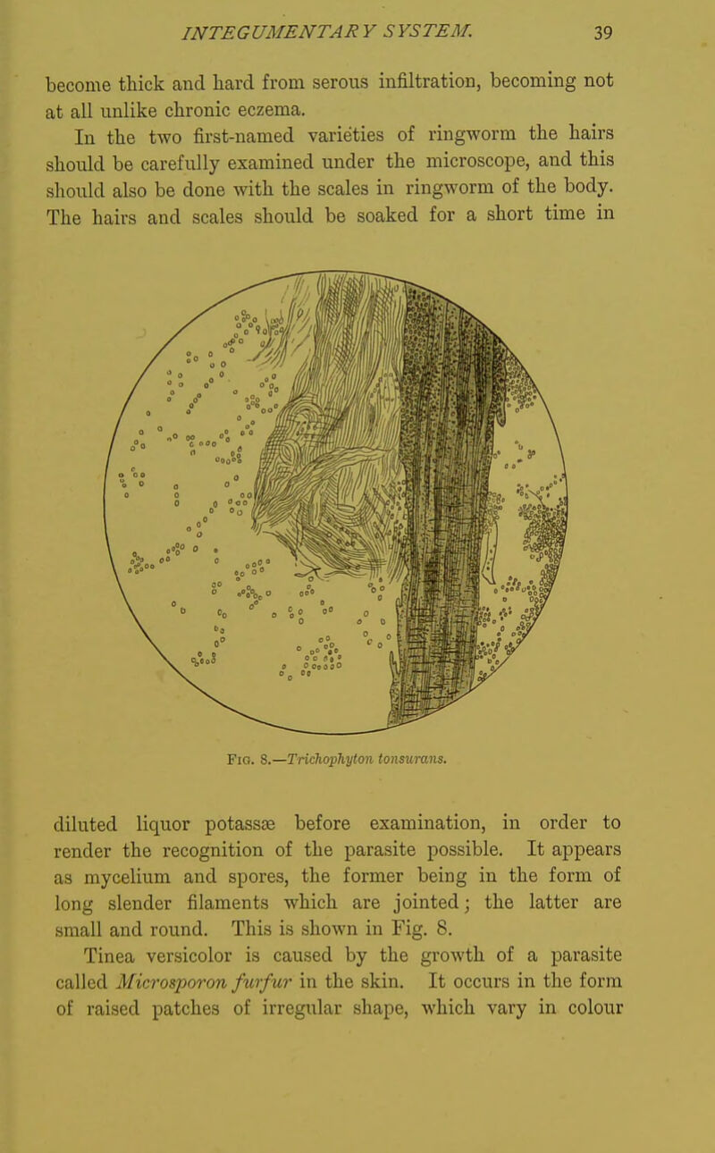 become thick and liard from serous infiltration, becoming not at all unlike chronic eczema. In the two first-named varieties of ringworm the hairs should be carefully examined under the microscope, and this should also be done with the scales in ringworm of the body. The hairs and scales should be soaked for a short time in Fig. 8.—Trichophyton tonsurans. diluted liquor potassse before examination, in order to render the recognition of the parasite possible. It appears as mycelium and spores, the former being in the form of long slender filaments which are jointed; the latter are small and round. This is shown in Fig. 8. Tinea versicolor is caused by the growth of a parasite called Microsporon furfur in the skin. It occurs in the form of raised patches of irregular shape, which vary in colour