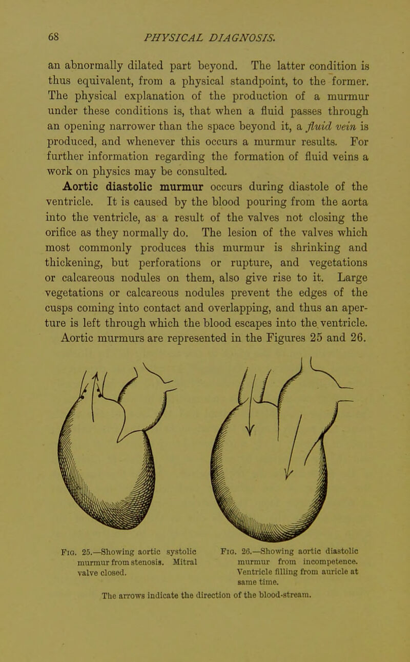 an abnormally dilated part beyond. The latter condition is thus equivalent, from a physical standpoint, to the former. The physical explanation of the production of a murmur under these conditions is, that when a fluid passes through an opening narrower than the space beyond it, a fluid vein is produced, and whenever this occurs a murmur results. For further information regarding the formation of fluid veins a work on physics may be consulted. Aortic diastolic murmur occurs during diastole of the ventricle. It is caused by the blood pouring from the aorta into the ventricle, as a result of the valves not closing the orifice as they normally do. The lesion of the valves which most commonly produces this murmur is shrinking and thickening, but perforations or rupture, and vegetations or calcareous nodules on them, also give rise to it. Large vegetations or calcareous nodules prevent the edges of the cusps coming into contact and overlapping, and thus an aper- ture is left through which the blood escapes into the, ventricle. Aortic murmurs are represented in the Figures 25 and 26. Fm. 25.—Showing aortic systolic Fig. 26.—Showing aortic diastolic murmur from stenosis. Mitral murmur from incompetence, valve closed. Ventricle filling from auricle at same time.