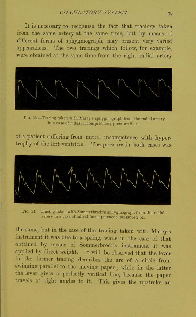 It is necessary to recognise the fact that tracings taken from the same artery at the same time, but by means of different forms of sphygmograph, may present very varied appearances. The two tracings which follow, for example, were obtained at the same time from the right radial artery Fio. 33.—Tracing taken with'Marey's sphygmograph from the radial artery in a case of mitral incompetence ; pressure 2 oz. of a patient suffering from mitral incompetence with hyper- trophy of the left ventricle. The pressure in both cases was Fio. 34.—Tracing taken with Sommerbrodt's sphygmograph from the radial artery in a case of mitral incompetence; pressure 2 oz. the same, but in the case of the tracing taken with Marey's instrument it was due to a spring, while in the case of that obtained by means of Sommerbrodt's instrument it was applied by direct weight. It will be observed that the lever in the former tracing describes the arc of a circle from swinging parallel to the moving paper; while in the latter the lever gives a perfectly vertical line, because the paper travels at right angles to it. This gives the upstroke an