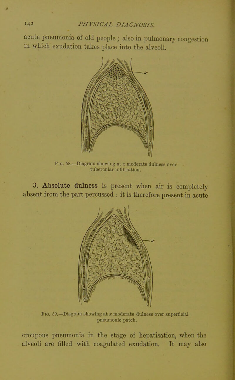 acute pneumonia of old people; also in pulmonary congestion in which exudation takes place into the alveoli. Fig. 58.—Diagram showing at x moderate dulness over tubercular infiltration. 3. Absolute dulness is present when air is completely absent from the part percussed : it is therefore present in acute Fig. 59.—Diagram showing at x moderate dulness over superficial pneumonic patch. croupous pneumonia in the stage of hepatisation, when the alveoli are filled with coagulated exudation. It may also