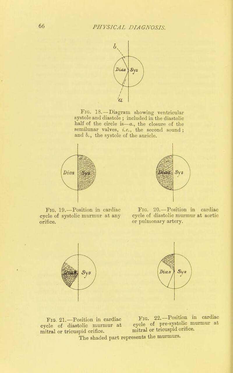 Fio. 18.—Diagram showing ventricular systole and diastole ; included in the diastoHc half of the circle is—a., the closure of the semilunar valves, i.e., the second sound; and J., the systole of the auricle. Fig. 19.—Position in cardiac cycle of systolic murmur at any orifice. Fig. 20.—Position in cardiac cycle of diastolic murmur at aortic or pulmonary artery. Fio, 21.-Position in cardiac FiG. 22.-Position m cardiac cycle of diastolic murmur at cycle of pre-systolic murmur at mitral or tricuspid orifice. mitral or tricuspid orifice. The shaded part represents the murmurs.