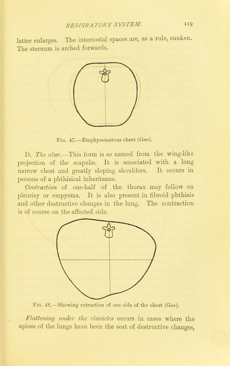 latter enlarges. The intercostal spaces are, as a nUe, sunken. The sternum is arched forwards. Fig. 47.—Emphysematous chest (Gee). D. The alar.—This form is so named from the wing-like projection of the scapuliB. It is associated with a long narrow chest and greatly sloping shoulders. It occurs in persons of a phthisical inheritance. Contraction of one-half of the thorax may follow on pleurisy or empyema. It is also present in fibroid phthisis and other destructive changes in the lung. The contraction is of course on the affected side. Fig. 48.—Showing retraction of one side of the chest (Gee). Flattening under the clavicles occurs in cases where the apices of the lungs have been the seat of destructive changes,