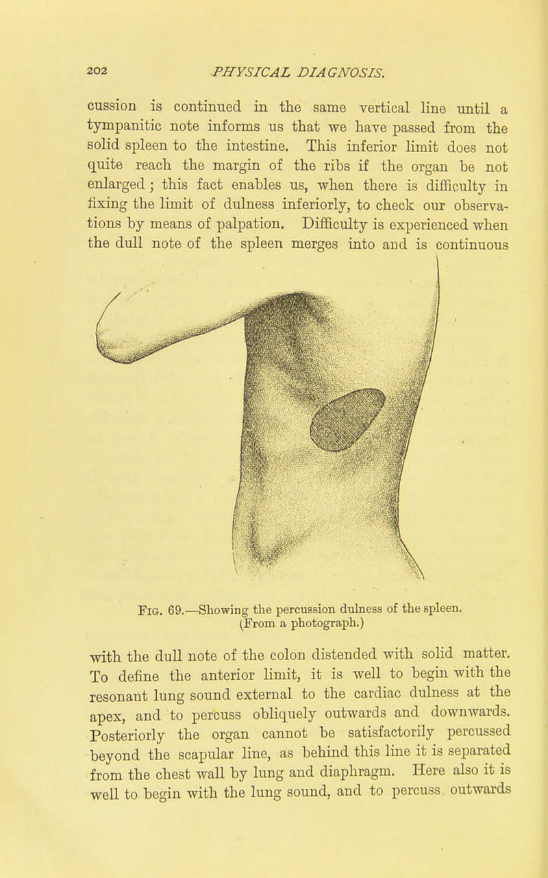 cussion is continued in the same vertical line until a tympanitic note informs us that we have passed from the solid spleen to the intestine. This inferior limit does not quite reach the margin of the ribs if the organ be not enlarged; this fact enables us, when there is difficulty in fixing the limit of dulness interiorly, to check our observa- tions by means of palpation. Difficulty is experienced when the dull note of the spleen merges into and is continuous Fig. 69.—Showing the percussion dulness of the spleen. (From a photograph.) with the duU note of the colon distended with solid matter. To define the anterior limit, it is well to begin with the resonant lung sound external to the cardiac dulness at the apex, and to percuss obliquely outwards and downwards. Posteriorly the organ cannot be satisfactorily percussed beyond the scapular line, as behind this line it is separated from the chest wall by lung and diaphragm. Here also it is well to begin with the lung sound, and to percuss outwards