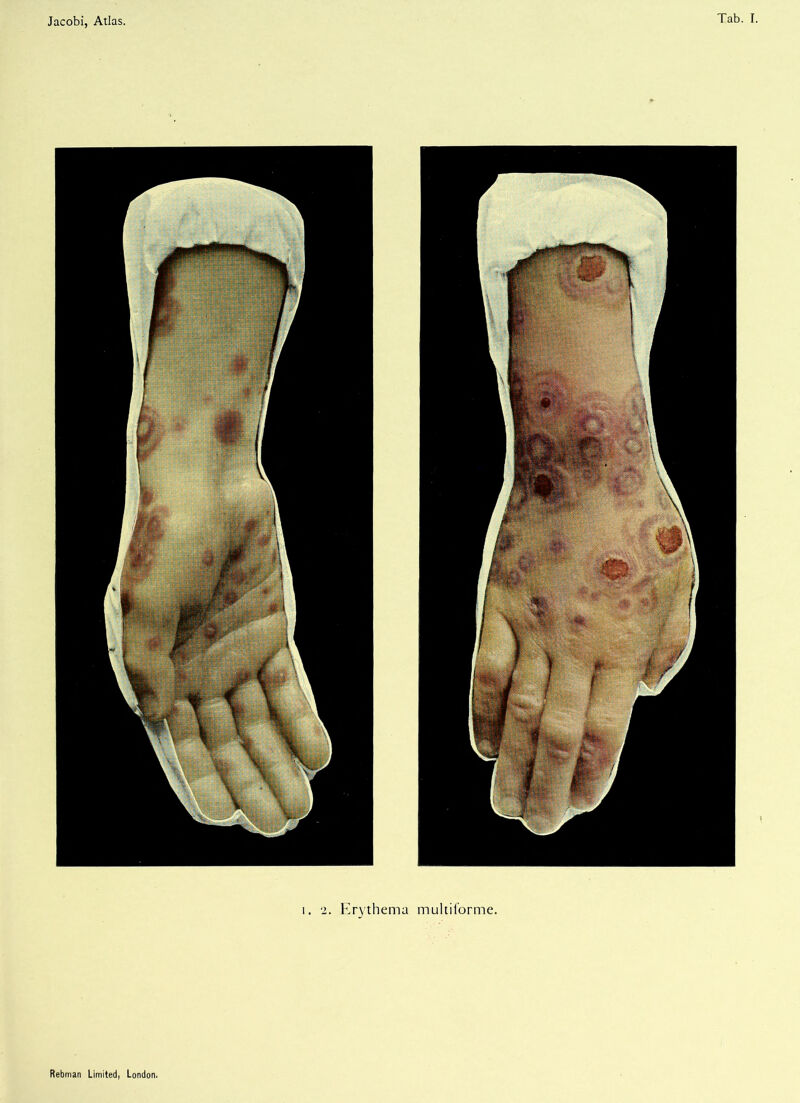 i. 2. Erythema multiforme.