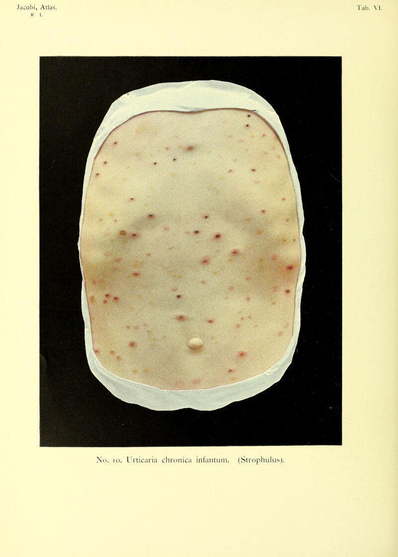 R L No. 10. Urticaria chronica infantum. (Strophulus).