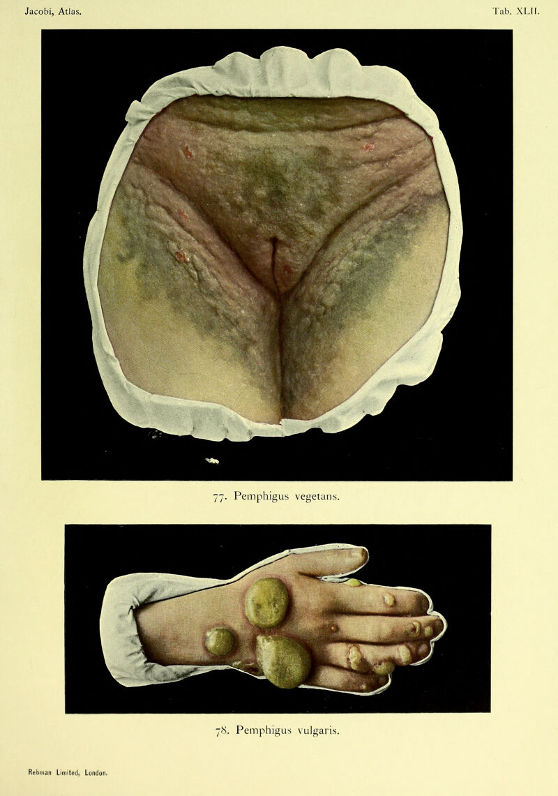 78. Pemphigus vulgaris.