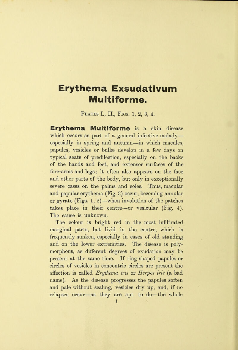 Erythema Exsudativum Multiforme. Plates L, II., Figs. 1, 2, 3, 4. Erythema Multiforme is a skin disease which occurs as part of a general infective malady— especially in spring and autumn—in which macules, papules, vesicles or bullse develop in a few days on typical seats of predilection, especially on the backs of the hands and feet, and extensor surfaces of the fore-arms and legs; it often also appears on the face and other parts of the body, but only in exceptionally severe cases on the palms and soles. Thus, macular and papular erythema (Fig. 3) occur, becoming annular or gyrate (Figs. 1, 2)—when involution of the patches takes place in their centre—or vesicular (Fig. 4). The cause is unknown. The colour is bright red in the most infiltrated marginal parts, but livid in the centre, which is frequently sunken, especially in cases of old standing and on the lower extremities. The disease is poly- morphous, as different degrees of exudation may be present at the same time. If ring-shaped papules or circles of vesicles in concentric circles are present the affection is called Erythema iris or Herpes iris (a bad name). As the disease progresses the papules soften and pale without scaling, vesicles dry up, and, if no relapses occur—as they are apt to do—the whole