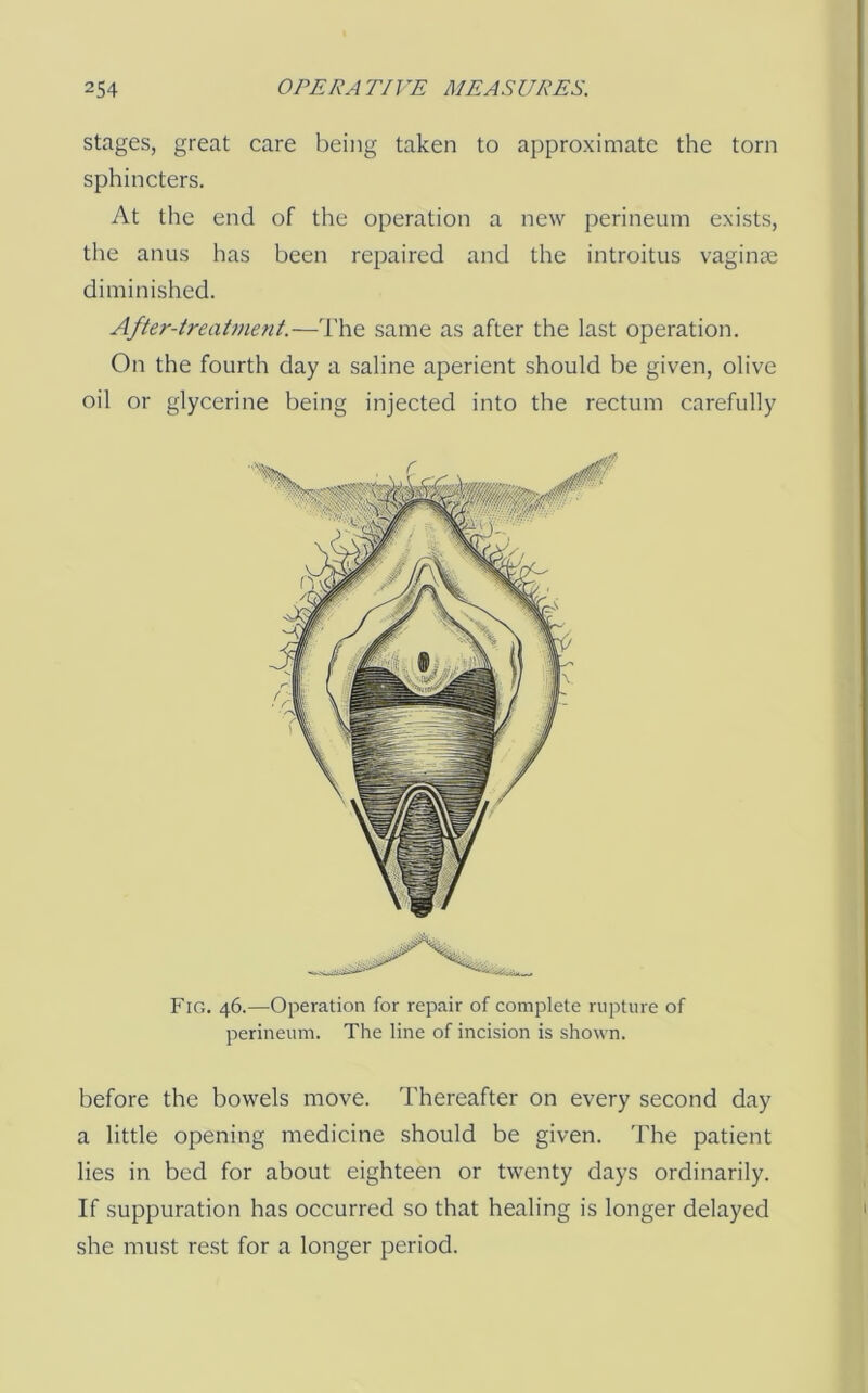 stages, great care being taken to approximate the torn sphincters. At the end of the operation a new perineum exists, the anus has been repaired and the introitus vaginae diminished. After-treaOnent.—The same as after the last operation. On the fourth day a saline aperient should be given, olive oil or glycerine being injected into the rectum carefully before the bowels move. Thereafter on every second day a little opening medicine should be given. The patient lies in bed for about eighteen or twenty days ordinarily. If suppuration has occurred so that healing is longer delayed she must rest for a longer period. Fig. 46.—Operation for repair of complete rupture of perineum. The line of incision is shown.