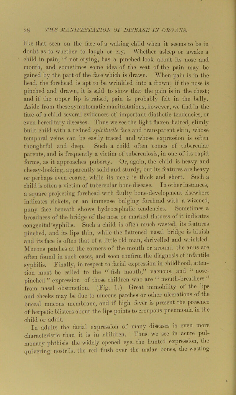 like that seen on the face of a waking child when it seems to be in donbt as to whether to langh or cry. Whether asleep or awake a child in pain, if not crying, has a pinched look about its nose and mouth, and sometimes some idea of the seat of the pain may be gained by the part of the face which is drawn. When pain is in the head, the forehead is apt to be wrinkled into a frown; if the nose is pinched and drawn, it is said to show that the pain is in the chest; and if the upper lip is raised, pain is probably felt in the belly. Aside from these symptomatic manifestations, however, we find in the face of a child several evidences of important diathetic tendencies, or even hereditary diseases. Thus we see the light flaxen-liaired, slimly built child with a refined spirituelle face and transparent skin, whose temporal veins can be easily traced and whose expression is often thoughtful and deep. Such a child often comes of tubercular parents, and is frc(|uently a victim of tuberculosis, in one of its rapid forms, as it apjn’oachcs puberty. Or, again, the child is heavy and cheesy-looking, apparently solid and sturdy, but its features are heavy or perhaps even coarse, while its neck is thick and short. Such a child is often a victim of tubercular bone disease. In other instances, a square projecting forehead with faulty bone-development elsewhere indicates rickets, or an immense bulging forehead with a wizened, puny face beneath shows hydrocephalic tendencies. Sometimes a broadness of the bridge of the nose or marked flatness of it indicates congenital'syphilis. Such a child is often much wasted, its features pinched, and its lips thin, while the flattened nasal bridge is bluish and its face is often that of a little old man, shrivelled and wrinkled. Mucous patches at the corners of the month or around the anus are often found in such cases, and soon confirm the diagnosis of infantile syphilis. Finally, in respect to facial expression in childhood, atten- tion must be called to the ‘‘ fish mouth,’’ vacuous, and nose- pinched ” expression of those children who are mouth-breatheis from nasal obstruction. (Fig. 1.) Great immobility of the lips and cliceks may be due to niucous patches or other ulcerations of the buccal mucous membrane, and if high fever is present the presence of herpetic blisters about the lips points to croupous pneumonia in the child or adult. In adults the facial expression of many diseases is even more characteristic than it is in children. Thus we see in acute pul- monary phthisis the widely opened eye, the hunted expression, the quivering nostrils, the red flush over the malar bones, the wasting