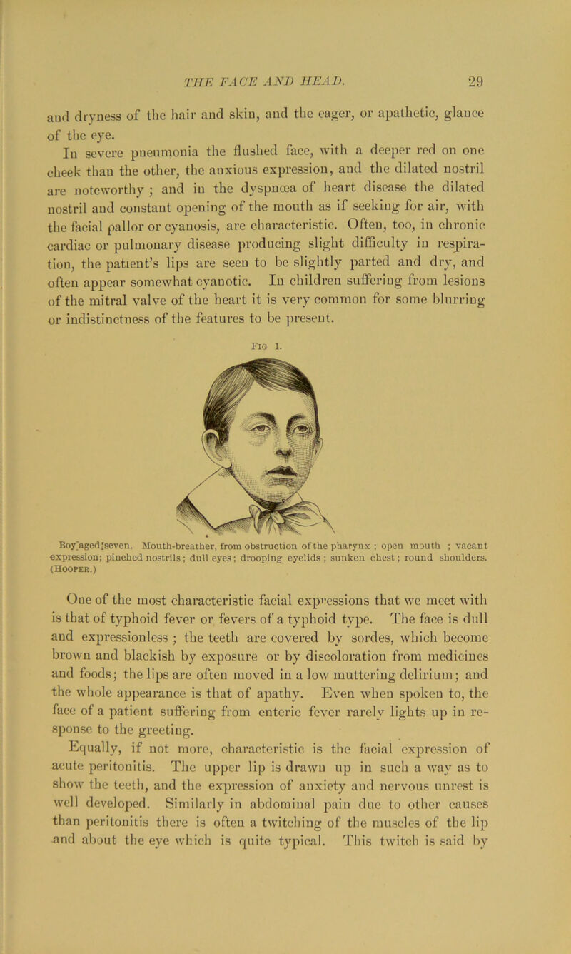 aud dryness of the hair and skin, and the eager, or apathetic, glance of the eye. In severe pneumonia the flushed face, with a deeper red on one cheek than the other, the anxious expression, and the dilated nostril are noteworthy ; and in the dyspnoea of heart disease the dilated nostril and constant opening of the mouth as if seeking for air, with the facial pallor or cyanosis, are characteristic. Often, too, in chronic cardiac or pulmonary disease producing slight difficulty in respira- tion, the patient’s lips are seen to be slightly parted and dry, and often appear somewhat cyanotic. In children suffering from lesions of the mitral valve of the heart it is very common for some blurring or indistinctness of the features to be present. Fig 1. Boy'agedjseven. Mouth-breather, from obstruction of the pharynx ; open mouth ; vacant expression; pinched nostriis; dull eyes; drooping ej'elids ; sunken chest; round shoulders. (Hooper.) One of the most characteristic facial expi’essions that we meet with is that of typhoid fever or fevers of a typhoid type. The face is dull aud expressionless ; the teeth are covered by sordes, which become brown and blackish by exposure or by discoloration from medicines and foods; the lips are often moved in a low muttering delirium; and the whole appearance is that of apathy. Even when spoken to, the face of a patient suffering from enteric fever rarely lights up in re- sponse to the greeting. Equally, if not more, characteristic is the facial expression of acute peritonitis. The upper lip is drawn up in such a way as to show the teeth, and the expression of anxiety and nervous unrest is well developed. Similarly in abdominal pain due to other causes than peritonitis there is often a twitching of the mu.scles of the lip and about the eye which is quite typical. This twitch is said by