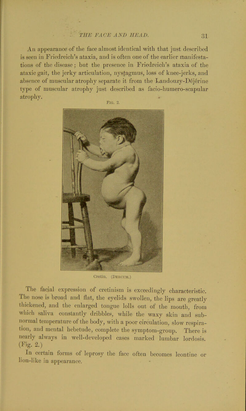 An appearance of the face almost identical with that just described is seen in Friedreich’s ataxia, and is often one of the earlier manifesta- tions of the disease; but the presence in Friedreich’s ataxia of the ataxic gait, the jerky articulation, nystagmus, loss of knee-jerks, and absence of muscular atrophy separate it from the Landouzy-D6j6rine type of muscular atrophy just described as facio-humero-scapular atrophy. Fig. 2. Cretin. (Dercum.) The facial expression of cretinism is exceedingly characteristic. Phe nose is broad and flat, the eyelids swollen, the lips are gi’eatly thickened, and the enlarged tongue lolls out of the mouth, from which .saliva constantly dribbles, while the waxy skin and sub- normal temperature of the body, with a poor circulation, slow respira- tion, and mental hebetude, complete the symptom-group. There is nearly always in well-developed cases marked lumbar lordosis. (Fig. 2.) In certain forms of leprosy the face often becomes leontine or lion-like in ajipearauce.