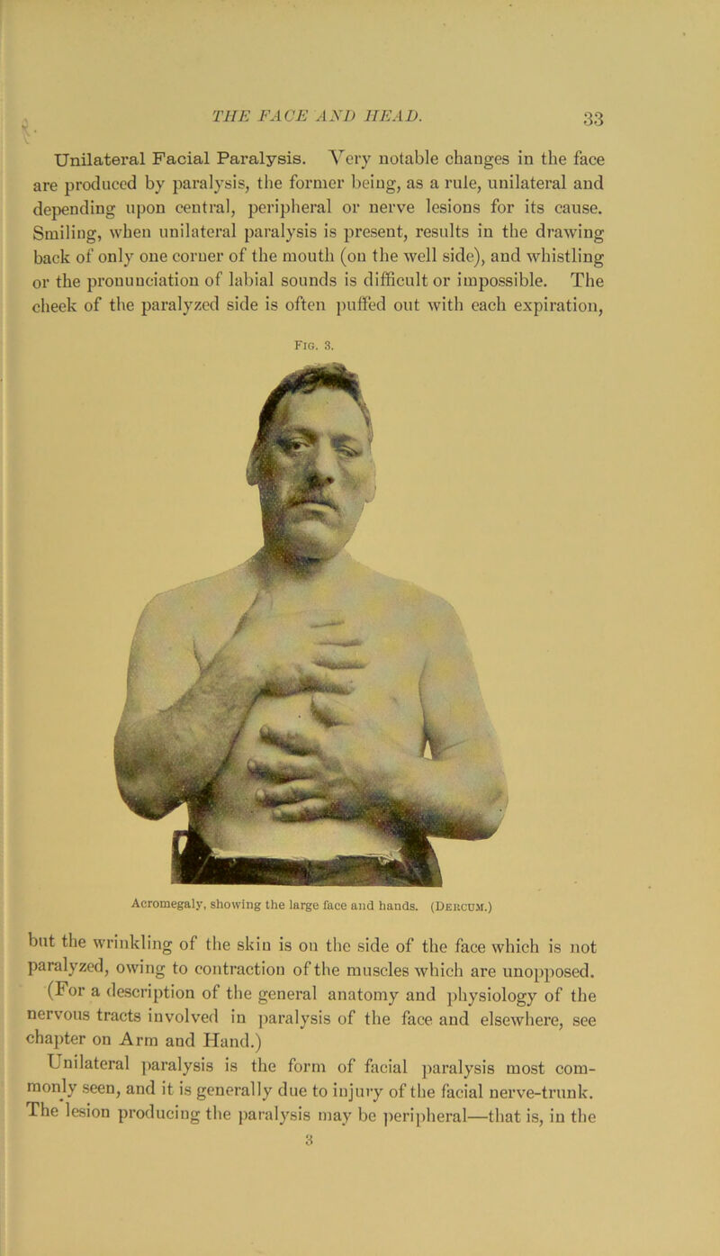 Unilateral Facial Paralysis. Very notable changes in the face are produced by paralysis, the former being, as a rule, unilateral and depending upon central, peripheral or nerve lesions for its cause. Smiling, when unilateral paralysis is present, results in the drawing back of only one corner of the mouth (on the well side), and whistling or the pronunciation of labial sounds is difficult or impossible. The cheek of the paralyzed side is often puffed out with each expiration. Fig. 3. but the wrinkling of the skin is on the side of the face which is not paralyzed, owing to contraction of the muscles which are unopposed. (For a description of the general anatomy and physiology of the nervous tracts involved in ])aralysis of the face and elsewhere, see chapter on Arm and Hand.) Unilateral paralysis is the form of facial ])aralysis most com- monly seen, and it is generally due to injury of the facial nerve-trunk. The lesion producing the paralysis may be perijiheral—that is, in the Acromegaly, showing the large face and hands. (Dercum.)