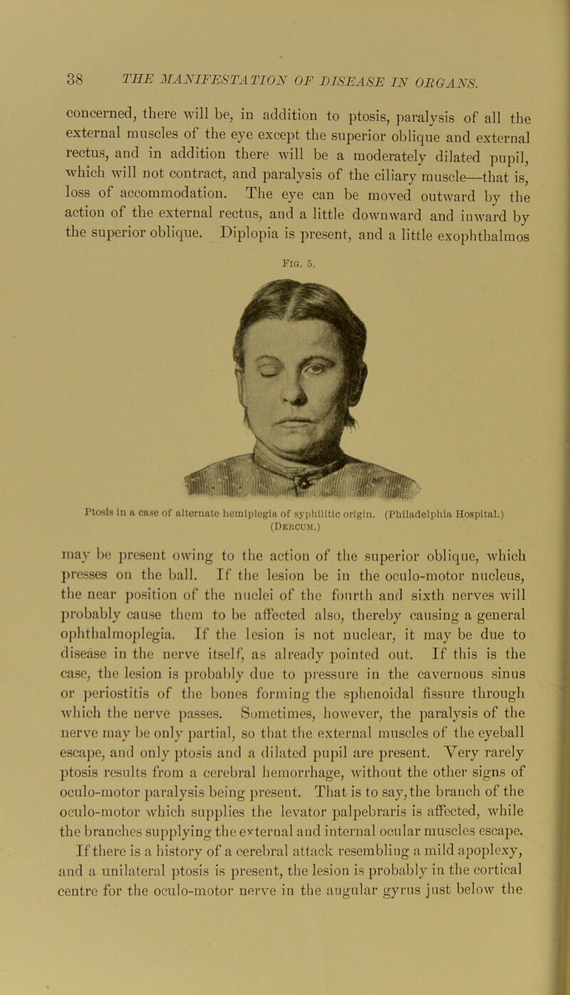 concerned, there will be, in addition to ptosis, paralysis of all the external muscles of the eye except the superior oblique and external rectus, and in addition there will be a moderately dilated pupil, which will not contract, and paralysis of the ciliary muscle—that is, loss of accommodation. The eye can be moved outward by the action of the external rectus, and a little downward and inward by the superior oblique. Diplopia is present, and a little exophthalmos Fig. 5. Ptosis in a case of alternate hemiplegia of syphilitic origin. (Philadelphia Hospital.) (Dkkcum.) may be present owing to the action of the superior oblique, which pre.sses on the ball. If the lesion be in the oculo-motor nucleus, the near position of the nuclei of the fourth and sixth nerves will probably cau.se them to be affected also, thereby causing a general ophthalmoplegia. If the lesion is not nuclear, it may be due to disease in the nerve itself, as already pointed out. If this is the case, the lesion is probalily due to pressure in the cavernous .sinus or periostitis of the bones forming the sphenoidal fissure through which the nerve passes. Sometimes, however, the paralysis of the nerve may be only partial, so that the external muscles of the eyeball escape, and only ptosis and a dilated pupil are pre.sent. Very rarely ptosis results from a cerebral hemorrhage, without the other signs of oculo-motor paralysis being present. That is to say,the branch of the oculo-motor which supplies the levator palpebraris is affected, while the branches supplying the external and internal ocular muscles escape. If there is a history of a cerebral attack re.sembling a mild apoplexy, and a unilateral ptosis is present, the lesion is probably in the cortical centre for the oculo-motor nerve in the angular gyrus just below the