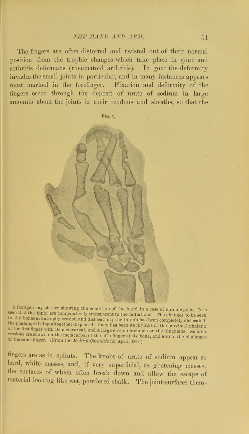 The fingers are often distorted and twisted out of their normal position from the trophic changes which take place in gout and arthritis deformans (rheumatoid arthritis). In gout the deformity invades the small joints in particular, and in many instances appears most marked in the forefinger. Fixation and deformity of the fingers occur through the deposit of urate of sodium in large amounts about the joints in their tendons and sheaths, so that the Fig. 9. A Rcintgen ray picture showing the condition of the hand in a case of chronic gout. It is seen that the tophi are comparatively transparent to the radiations. The changes to be seen in the hones are atrophy-erosion and dislocation ; the thumb has been completely dislocated, being altogether displaced ; there has been anchylosis of the proximal phalanx of the first finger with its metacarpal, and a large erosion is shown on the ulnar side. Smaller erosions are shown on the metacarpal of the fifth finger at its bone, and also in the phalanges of the same finger. (From the Medical Chronicle for April, 1896.) fingers are as in splints. The knobs of urate of sodium appear as hard, white mas.ses, and, if very superficial, as glistening masse.«, the surfaces of which often break down and allow the escape of material looking like wet, powdered chalk. The joint-surfaces them-