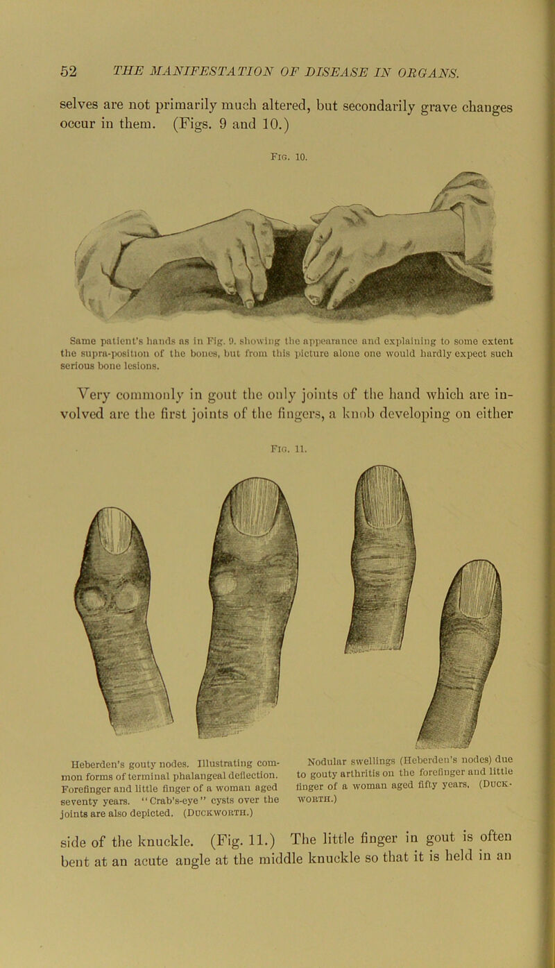 selves are not primarily much altered, but secondarily grave changes occur in them. (Figs. 9 and 10.) Fig. 10. Same patient’s liand.s ns in Fig. 9. showing tlie npi>earance and explaining to some extent the supra-position of the bones, but from this picture alone one would hardly expect such serious bone lesions. Very commonly in gout the only joints of the hand which are in- volved are the first joints of the fingers, a knob developing on either Fig. 11. Heberden’s gouty nodes. Illustrating com- mon forms of terminal iihalangeal deflection. Forefinger and little finger of a woman aged seventy years. “Crab’s-eye” cysts over the joints are also depicted. (Dockwokth.) Nodular swellings (Heberden’s nodes) due to gouty arthritis on the forefinger and little finger of a woman aged fifty years. (Duck- worth.) side of the knuckle. (Fig. 11.) The little finger in gout is often bent at an acute angle at the middle knuckle so that it is held in an