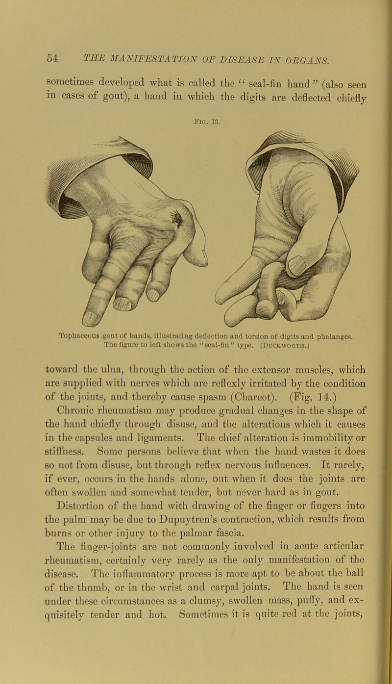 sometimes developed what is called the seal-fin hand’’ (also seen in cases of gout), a hand in which the digits are deflected chiefly Fig. 13. Tophaceous gout of hands, illustrating deflection and torsion of digits and phalanges. Tlio figure to left sliows the “ seal-flu ” type. (Duckworth.) toward the ulna, through the action of the extensor muscle.s, which are supjilied with nerves which are reflexly irritated by the condition of the joints, and thereby cause spasm (Charcot). (Fig. 14.) Chronic rheumatism may jiroduce gr:idual changes in the shape of the hiind chiefly through disuse, and the alterations which it causes in the capsules and ligaments. The chief alteration is immobility or stiffness. Some persons believe that when the hand wastes it does 80 not from disuse, but through reflex nervous influences. It rarely, if ever, occurs in the htinds :done, out when it does the joints are often swollen and somewhat tender, but never hard as in gout. Distortion of the hand with drawing of the finger or fingers into the palm may be due to Dupuytren’s contraction, which results from burns or other injury to the palmar fascia. The finger-joints are not commonly involved in acute articular rheumatism, certainly very rarely as the only manifestation of the disease. The inflammatory process is more apt to be about the ball of the thumb, or in the wrist and carpal joints. The hand is seen under these circumstances as a clumsy, swollen mass, puffy, and ex- quisitely tender and hot. Sometimes it is quite red at the joints.