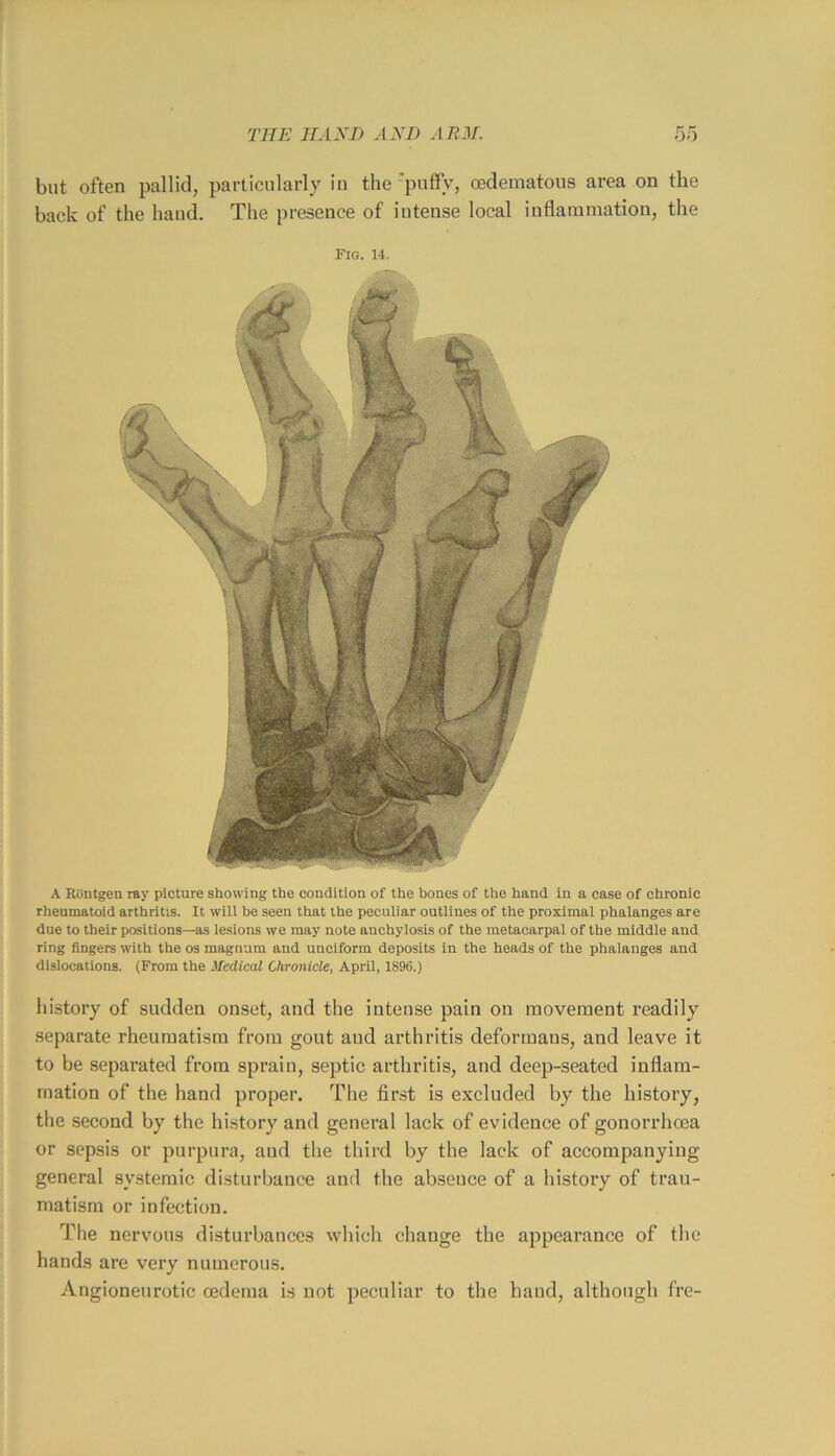 but often pallid, particularly iu the ’puffy, cedematous area on the back of the hand. The presence of intense local inflammation, the Fig. 14. A Riintgen ray picture showing the condition of the bones of the hand in a case of chronic rheumatoid arthritis. It will be seen that the peculiar outlines of the proximal phalanges are due to their positions—as iesions we may note anchylosis of the metacarpal of the middle and ring fingers with the os magnum and unciform deposits in the heads of the phaianges and dislocations. (From the Medical Chronicle, April, 1896.) history of sudden onset, and the intense pain on movement readily separate rheumatism from gout and arthritis deformans, and leave it to be separated from sprain, septic arthritis, and deep-seated inflam- mation of the hand proper. The first is excluded by the history, the second by the history and general lack of evidence of gonorrhoea or sepsis or purpura, and the third by the lack of accompanying general systemic disturbance and the absence of a history of trau- matism or infection. The nervous disturbances which change the appearance of the hands are very numerous. Angioneurotic oedema is not peculiar to the hand, although fre-