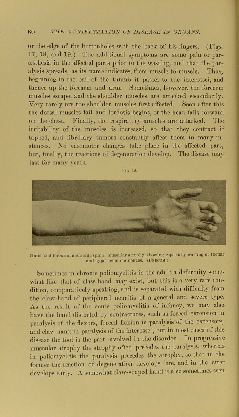 or the edge of the buttonholes with the back of his fingers. (Figs. 17, 18, and 19.) The additional syraptonas are some pain or par- sesthesia in the affected parts prior to the wasting, and that the par- alysis spreads, as its name indicates, from muscle to muscle. Thus, beginning in the ball of the thumb it passes to the interossei, and thence up the forearm and arm. Sometimes, however, the forearm muscles escape, and the shoulder muscles are attacked secondarily. Very rarely are the shoulder muscles first affected. Soon after this the dorsal muscles fail and lordosis begins, or the head falls forward on the chest. Finally, the respiratory muscles are attacked. The irritability of the muscles is increased, so that they contract if tapped, and fibrillary tumors constantly affect them in many in- stances. No vasomotor changes take place in the affected part, but, finally, the reactions of degeneration develop. The disease may last for many years. Fig. 19. Uand and forearm in chronic spinal muscular atrophy, showing c.spoclally wasting of thenar and hypothenar eminences. (Deucum.) Sometimes in chronic poliomyelitis in the adult a deformity some- what like that of claw-hand may exist, but this is a very rare con- dition, comparatively speaking, and is separated with difficulty from the claw-hand of peripheral neuritis of a general and severe type. As the result of the acute poliomyelitis of infancy, we may also have the hand distorted by contractures, such as forced extension in paralysis of the flexors, forced flexion in paralysis of the extensors, and claw-hand in paralysis of the interossei, but in most cases of this disease the foot is the part involved in the disorder. In progressive muscular atrophy the atrophy often precedes the paralysis, whereas in poliomyelitis the paralysis precedes the atrophy, so that in the former the reaction of degeneration develops late, and in the latter develops early. A somewhat claw-shaped hand is also sometimes seen