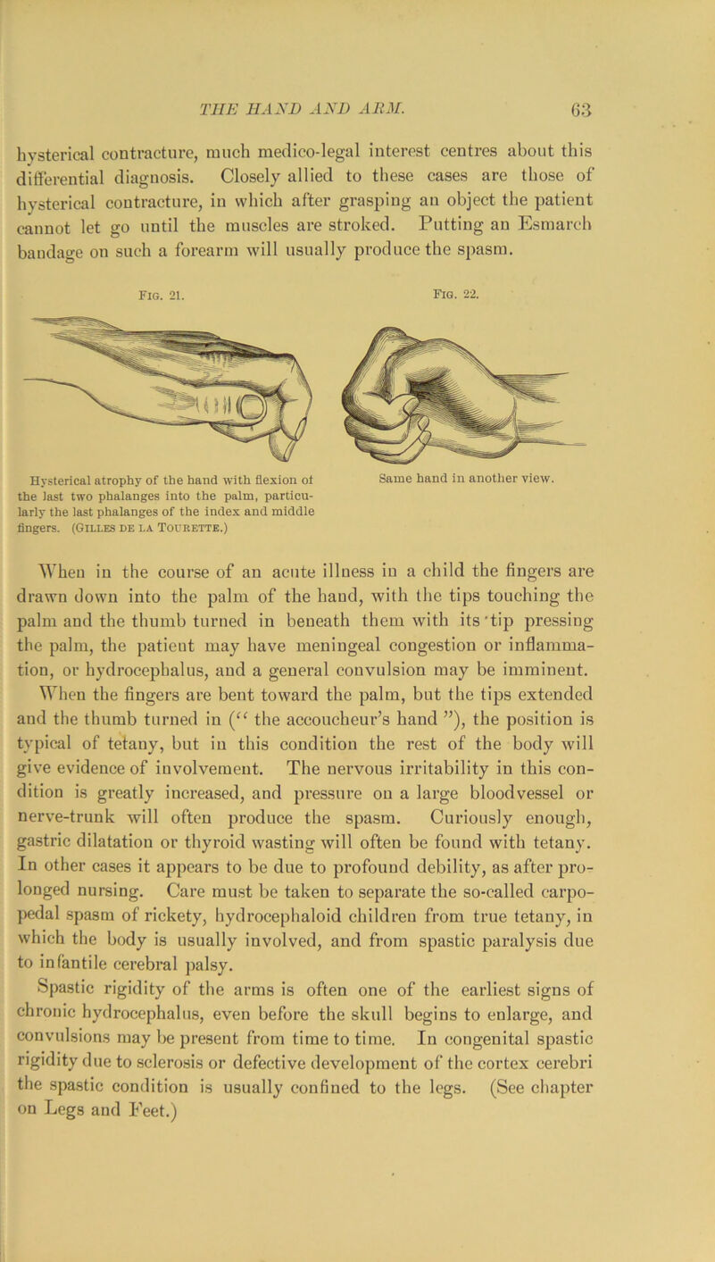 hysterical contracture, much medico-legal interest centres about this differential diagnosis. Closely allied to these cases are those of hysterical contracture, in which after grasping an object the patient cannot let go until the muscles are stroked. Putting an Esmarch bandage on such a forearm will usually produce the spasm. Fig. 21. Fig. 22. Hysterical atrophy of the hand with flexion ot the last two phalanges into the palm, particu- larly the last phalanges of the index and middle fingers. (Gilles de la Tourette.) Same hand in another view. Wheu in the course of an acute illness in a child the fingers are drawn down into the palm of the hand, with the tips touching the palm and the thumb turned in beneath them with its'tip pressing the palm, the patient may have meningeal congestion or inflamma- tion, or hydrocephalus, and a general convulsion may be imminent. When the fingers are bent toward the palm, but the tips extended and the thumb turned in the accoucheur’s hand ”), the position is typical of tetany, but in this condition the rest of the body will give evidence of involvement. The nervous irritability in this con- dition is greatly increased, and pressure on a large bloodvessel or nerve-trunk will often produce the spasm. Curiously enough, gastric dilatation or thyroid wasting will often be found with tetany. In other cases it appears to be due to profound debility, as after pro- longed nursing. Care must be taken to separate the so-called carpo- pedal spasm of rickety, hydrocephaloid children from true tetany, in which the body is usually involved, and from spastic paralysis due to infantile cerebral palsy. Spastic rigidity of the arms is often one of the earliest signs of chronic hydrocephalu.s, even before the skull begins to enlarge, and convulsions may be present from time to time. In congenital spastic rigidity due to sclerosis or defective development of the cortex cerebri the spastic condition is usually confined to the legs. (See chapter on Legs and Feet.)
