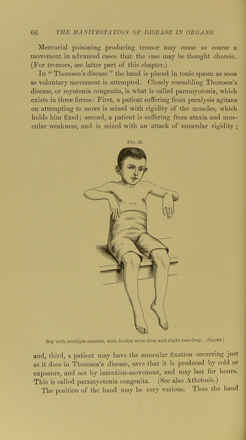 Mercurial poisoning producing tremor may cause so coarse a movement in advanced cases that the case may be thought choreic. (For tremors, see latter part of this chapter.) In “ Thomsen’s disease ” the hand is placed in tonic spasm as soon as voluntary movement is attempted. Closely resembling Thomsen’s disease, or myotonia congenita, is what is called paramyotonia, which exists in three forms: First, a patient suffering from paralysis agitans on attempting to move is seized with rigidity of the muscles, which holds him fixed; second, a patient is suffering from ataxia and mus- cular weakness, and is seized with an attack of muscular rigidity ; Fig. 23. Boy with multiple neuritis, with double wrist-drop and slight ioot-drop. (Sachs.) and, third, a patient may have the muscular fixation occurring just as it does in Thomsen’s disease, save that it is produced by cold or exposure, and not by intention-movement, and may last for hours. This is called paramyotonia congenita. (See also Athetosis.) The position of the hand may be very various. Thus the hand