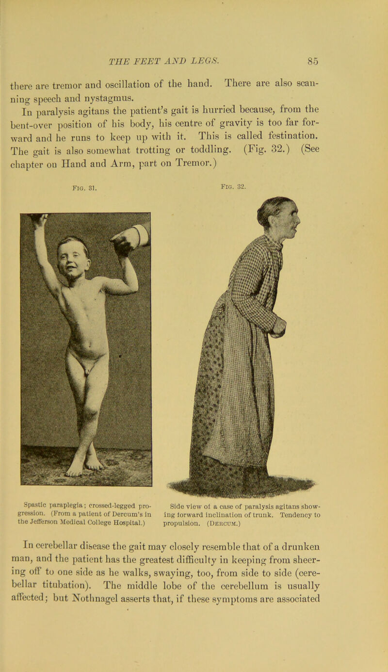 there are tremor and oscillation of the hand. There are also scan- ning speech and nystagmus. In paralysis agitans the patient's gait is hurried because, from the bent-over position of his body, his centre of gravity is too far for- ward and he runs to keep up with it. This is called lestination. The gait is also somewhat trotting or toddling. (Fig. 32.) (See chapter on Hand and Arm, part on Tremor.) Fig. 31. Fig. 32. Spastic i)araplegia; crossed-legged pro- Side view of a case of paralysis agitans show- gression. (From a patient of Dercum’s in ing forward inclination of trunk. Tendency to the Jefferson Medical College Hospital.) propulsion. (Deucum.) In cerebellar disease the gait may closely re.serable that of a drunken man, and the patient has the greatest difficulty in keeping from sheer- ing off to one side as he walks, swaying, too, from side to side (cere- bellar titubation). The middle lobe of the cerebellum is usually affected; but Nothnagel asserts that, if these symptoms are associated