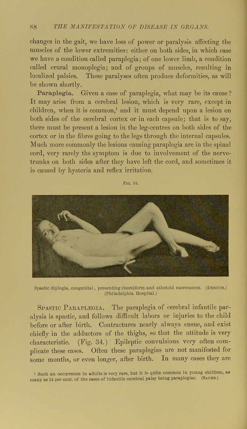 changes in the gait, we have loss of power or pai’alysis alfecting the muscles of the lower extremities: either on both sides, in which case we have a condition called paraplegia; of one lower limb, a condition called crural monoplegia; and of groups of muscles, resulting in localized palsies. These paralyses often produce deformities, as will be shown shortly. Paraplegia. Given a case of paraplegia, what may be its cause ? It may arise from a cerebral lesion, which is very rare, except in children, when it is common,^ and it must depeud upon a lesion on both sides of the cerebral cortex or in each capsule; that is to say, there must be present a lesion in the leg-centres on both sides of the cortex or in the fibres going to the legs through the internal capsules. Much more commonly the lesions causing paraplegia are in the spinal cord, very rarely ths symptom is due to involvement of the nerve- trunks on both sides after they have left the cord, and sometimes it is caused by hysteria and reflex irritation. Fig. 31. Spastic diplegia, congenital, presenting choreiform and athetoid movements. (Dercum.) (Philadelphia Hospital.) Spastic Paraplegia. Tlie paraplegia of cerebral infantile par- alysis is spastic, and follows difficult labors or injuries to the child before or after birth. Contractures nearly always ensue, and exist chiefly in the adductors of the thighs, so that the attitude is very characteristic. (Fig. 34.) Epileptic convulsions very often com- plicate these cases. Often these paraplegias are not manifested for some months, or even longer, after birth. In many cases they are 1 Such an occurrence in adults is very rare, but it is quite common in young children, as many as 14 per cent, of the cases of infantile cerebral palsy being paraplegias. (Sachs.)