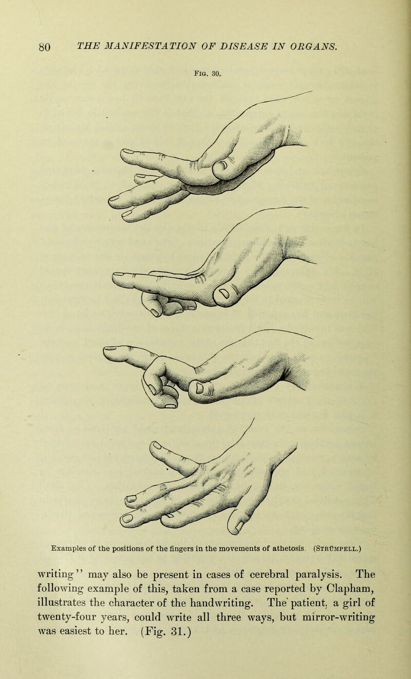 Fig. 30. Examples of the positions of the fingers in the movements of athetosis (Stp.Ompell.) writing ’ ’ may also be present in eases of cerebral paralysis. The following example of this, taken from a case reported by Clapham, illustrates the character of the handwriting. The' patient, a girl of twenty-four years, could write all three ways, but mirror-writing was easiest to her. (Fig. 31.)