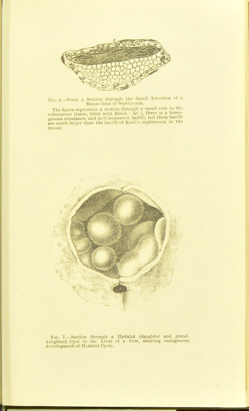 Fli:. «.—Kroiii a Section tlirousli the Small Intestine of ii Mouse ilwul of Scptira'inift. The tiKiive repieseiits a section tlirouuli a small vein in tlie subnmcons tissue, tilled wilh blood. At. 1, tliere is a lif>i0: cnous substance, ami in ir numerous bacilli, but these bacilli are iniicli larger than the Uneilli of Koch s septicieuiia m the mouse. Kio. 7._Seclion tliioucli a Ilydatid (daugliter and prand- ilaughter) Cyst in the Liver of a Cow, showing eiidogenons development of Hydatid Cysts. f 1