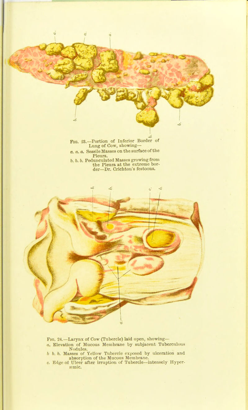 ~6 Fio. 23.—Portion of Inferior Border of Lung of Cow, showing— a. a.a. SessileMassesonthesurfaceofthe Pleura. b. b. h. Pedunculated Masses growing from the Pleura at the extreme bor- der—Dr. Crichtou's festoons. Fio. 24.—Larynx of Cow (Tubercle) laid open, showing— a. Elevation of Mucous Membrane by subjacent Tuborci\l(iu.s Nodules. h b. b. Masses of Yellow Tubercle exposed by ulceration and absorption of the Mucous Membrane, c. Edge o( Ulcer after irruption of Tubercle—intensely Hypcr- mmic.