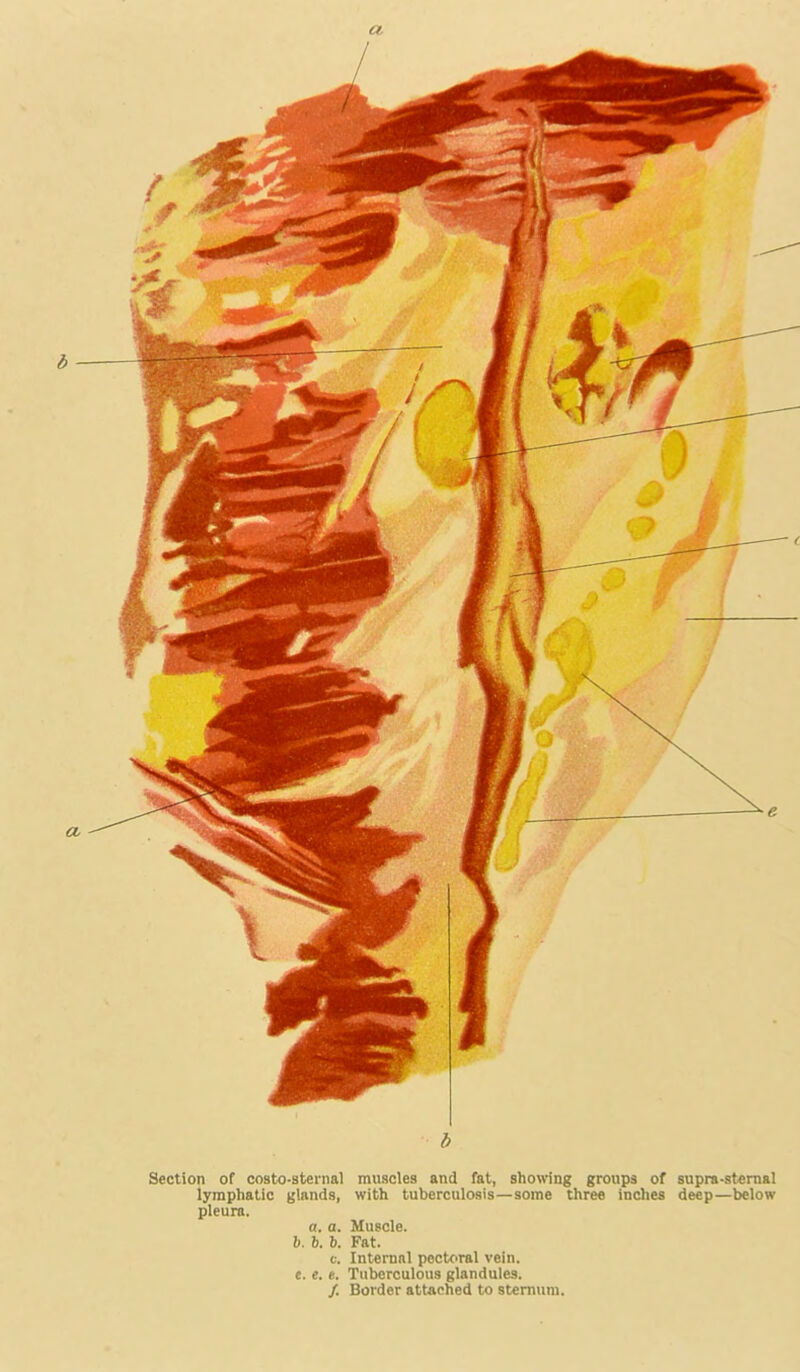 Section of costo-sternal muscles and fat, shotving groups of supra-stemal lymphatic glands, with tuberculosis—some three inches deep—below pleura. a. a. Muscle. 1. b. b. Fat. c. Internal pectoral vein, e. e. e. Tuberculous glandules. /. Border attached to sternum.