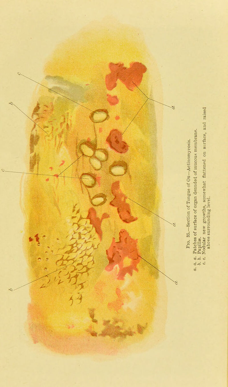 Fio. 35.—Section of Tongue of Ox—Actinomycosis. а. a. Patches of surface of organ denudeti of mucous membrane. б. b. Papillae. c. c. Nodular new growths, somewhat flattened on surface, and raised above surrounding level.