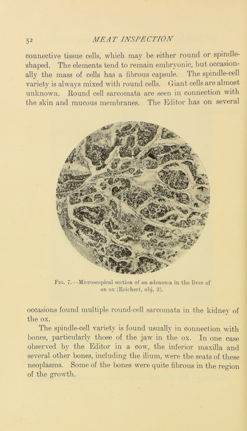 connective tissue cells, which may be either round or spindle- shaped. The elements tend to remain embryonic, but occasion- ally the mass of cells has a fibrous capsule. The spindle-cell variety is always mixed with round cells. Giant cells are almost unknown. Hound cell sarcomata are seen in connection with the skin and mucous membranes. The Editor has on several Fig. 7.—Microscopical section of an adenoma in the liver of an ox (Reichert, obj. 3). occasions found multiple round-cell sarcomata in the kidney of the ox. The spindle-cell variety is found usually in connection with bones, particularly those of the jaw in the ox. In one case observed by the Editor in a cow, the inferior maxilla and several other bones, including the ilium, were the seats of these neoplasms. Some of the bones were quite fibrous in the region of the growth.
