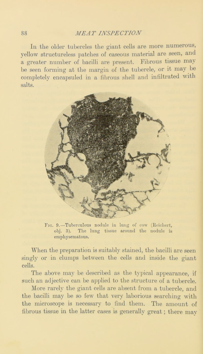 In the older tubercles the giant cells are more numerous, yellow structureless patches of caseous material are seen, and a greater number of bacilli are present. Fibrous tissue may be seen forming at the margin of the tubercle, or it may be completely encapsuled in a fibrous shell and infiltrated with salts. Fig. 9.—Tuberculous nodule in lung of cow (Reichert, obj. 3). The lung tissue around the nodule is emphysematous. When the preparation is suitably stained, the bacilli are seen singly or in clumps between the cells and inside the giant cells. The above may be described as the typical appearance, if such an adjective can be applied to the structure of a tubercle. More rarely the giant cells are absent from a tubercle, and the bacilli may be so few that very laborious searching with the microscope is necessary to find them. The amount of fibrous tissue in the latter cases is generally great; there mav