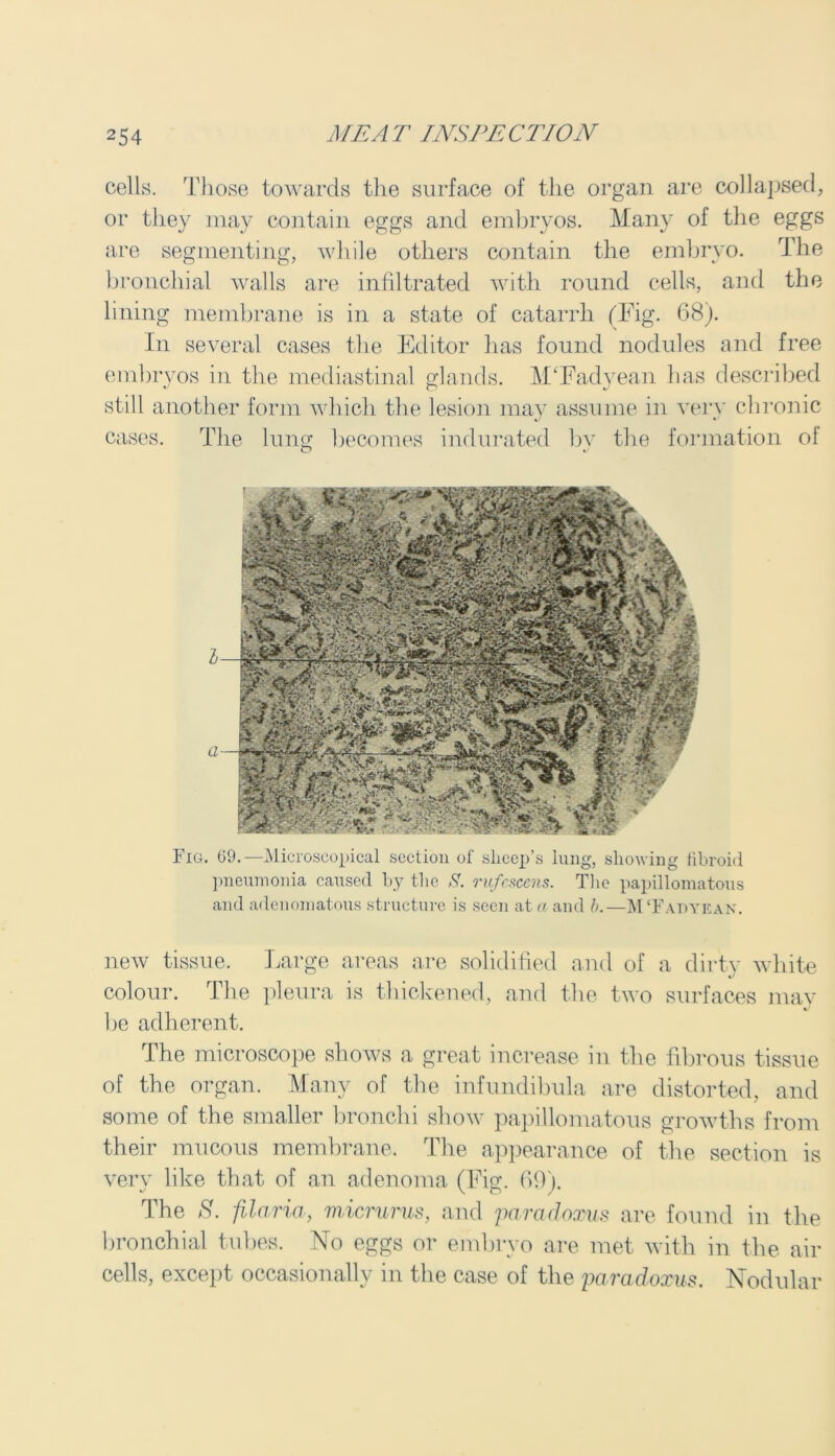 cells. Those towards the surface of the organ are collapsed, or they may contain eggs and embryos. Many of the eggs are segmenting, while others contain the embryo. The bronchial walls are infiltrated with round cells, and the lining membrane is in a state of catarrh (Fig. 68). In several cases the Editor has found nodules and free embryos in the mediastinal glands. M'Fadyean has described still another form which the lesion may assume in very chronic cases. The lung becomes indurated bv the formation of o Fig. 69.—Microscopical section of sheep’s lung, showing fibroid pneumonia caused by the S. rufcscens. The papillomatous and adenomatous structure is seen at a and b.—M‘Fat>yean. new tissue. Large areas are solidified and of a dirty white colour. The pleura is thickened, and the two surfaces may be adherent. The microscope shows a great increase in the fibrous tissue of the organ. Many of the infundibula are distorted, and some of the smaller bronchi show papillomatous growths from their mucous membrane. The appearance of the section is very like that of an adenoma (Fig. 69). The S. filaria, micrurus, and paradoxus are found in the bronchial tubes. No eggs or embryo are met with in the air cells, except occasionally in the case of the paradoxus. Nodular